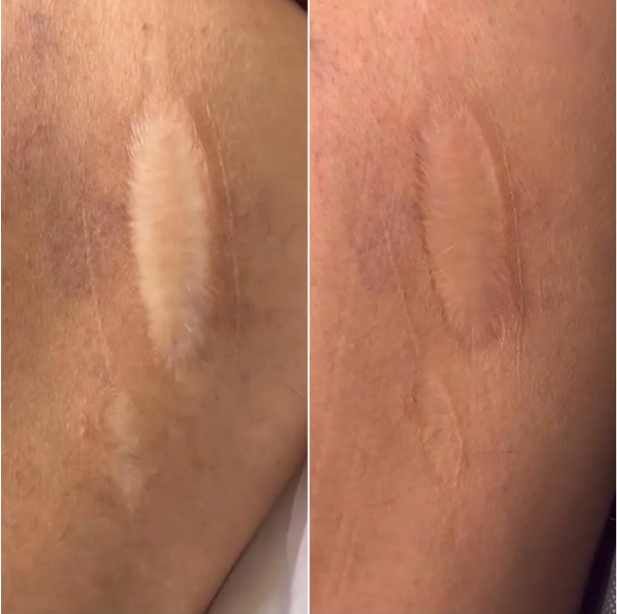Hypopigmented Scar - Camouflage Tattoo