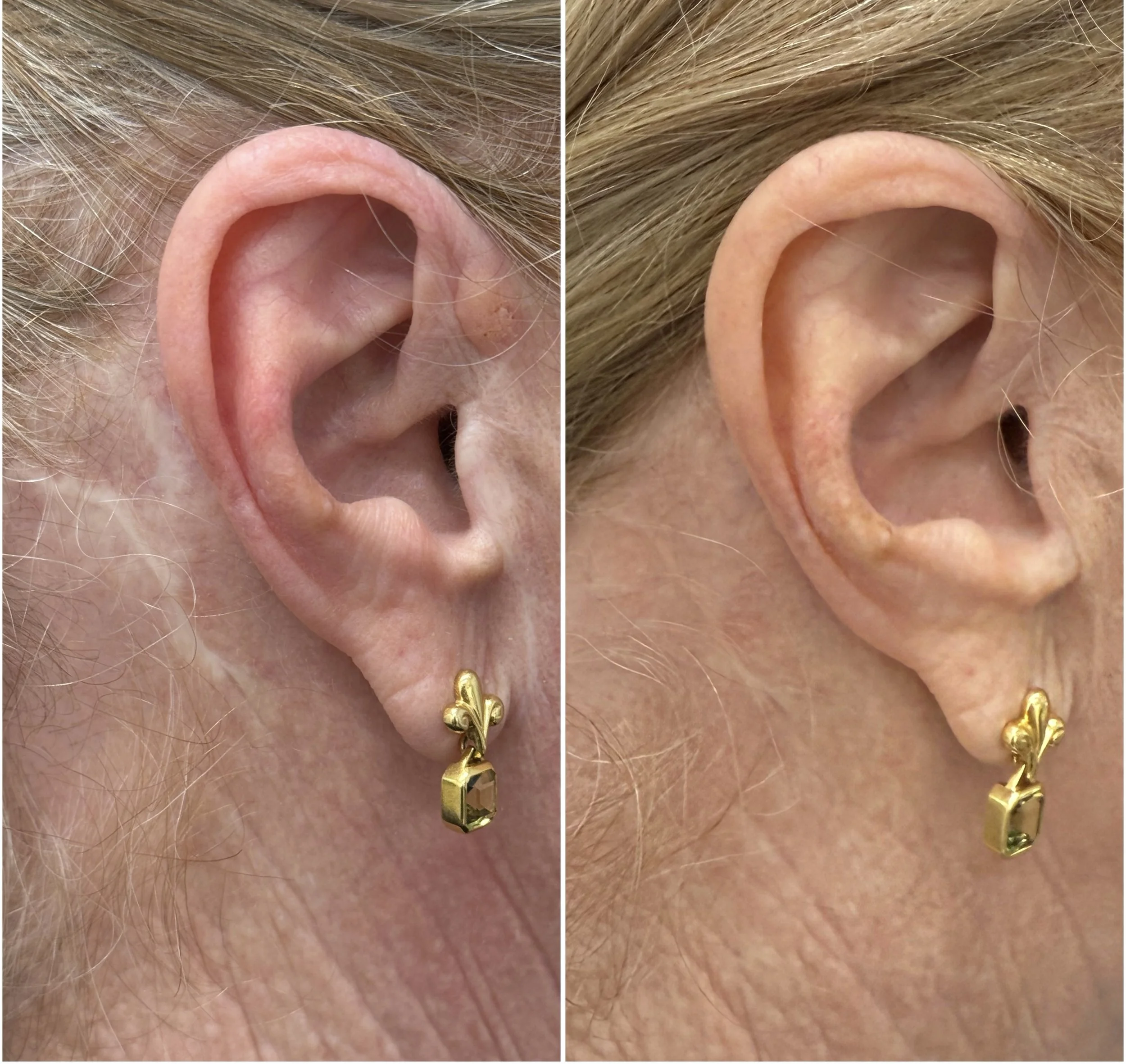 Facelift scars - Camouflage tattoo