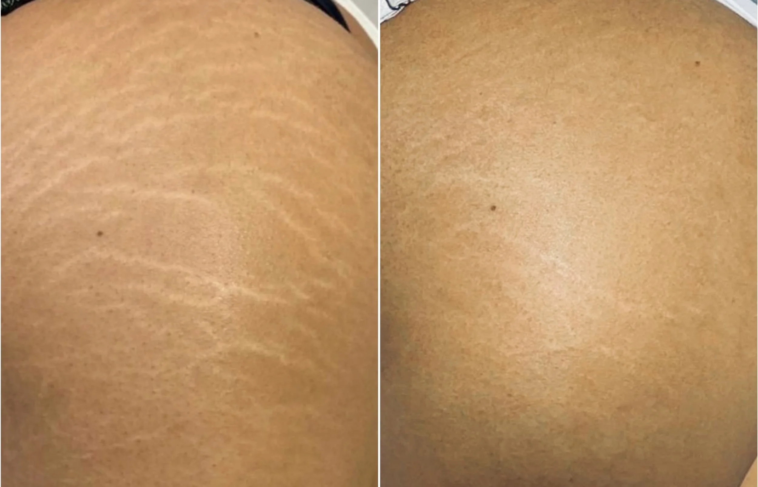 Natural looking stretch mark camouflage results on buttocks glutes bum – Sydney clinic
Stretch mark tattooing results– Sydney North Shore clinic
Best camouflage tattoo for stretch marks – Skin Conceal Sydney
Stretch mark treatment sydney