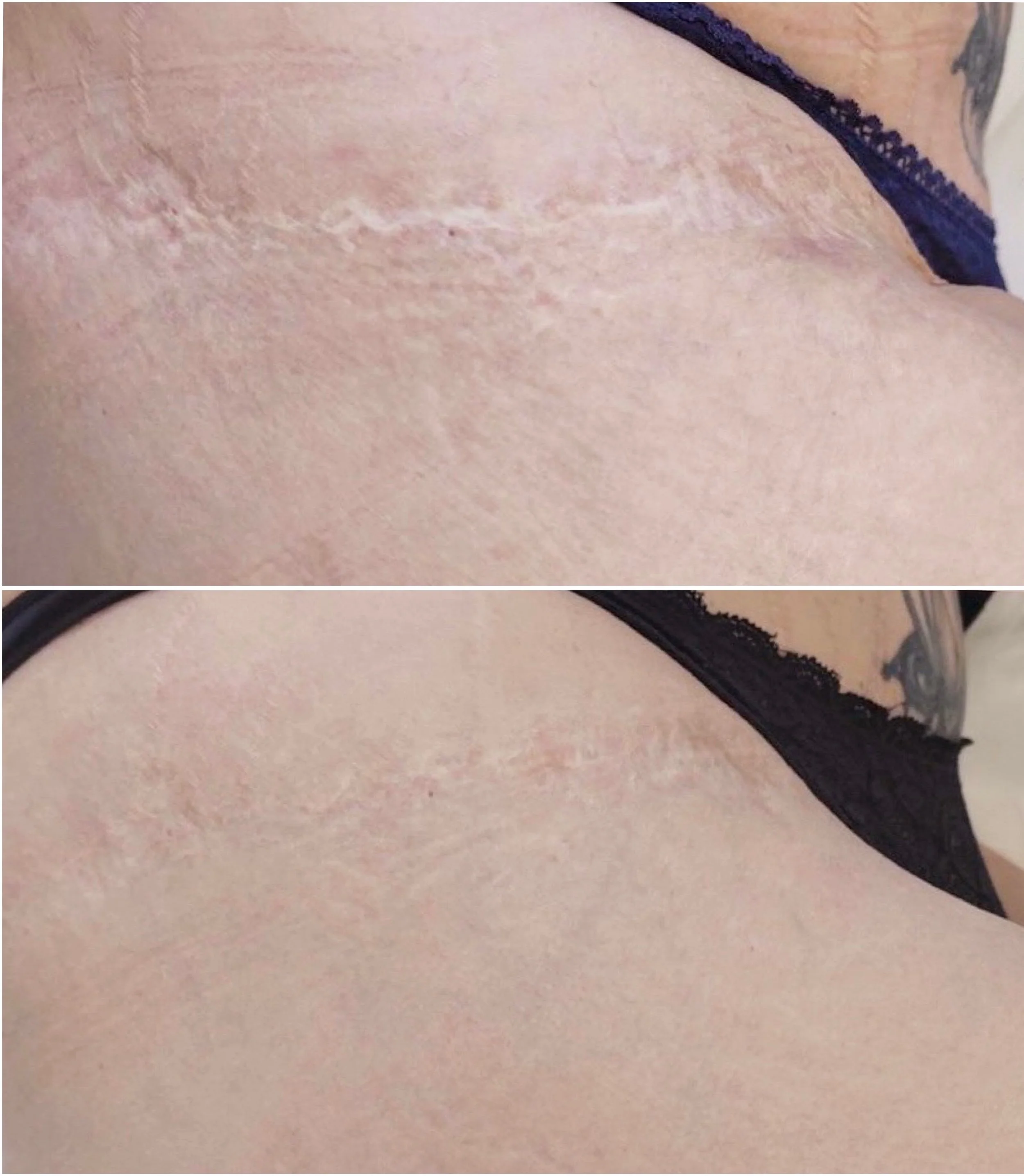 Close-up of a person's underarm showing the effects of deodorant or skincare treatment, with visible patches of dryness or skin irritation.