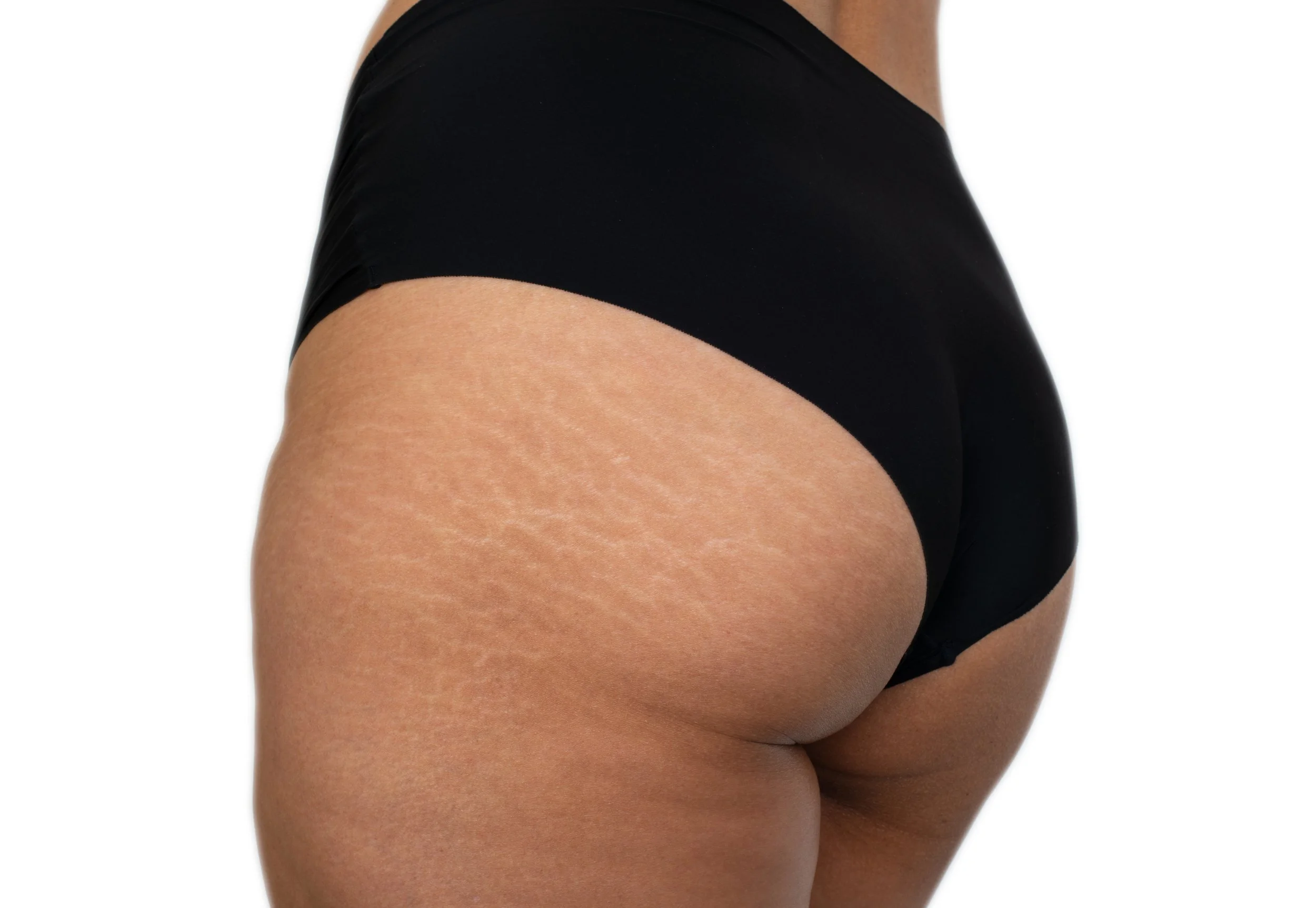 glute stretch marks black underwear.jpeg