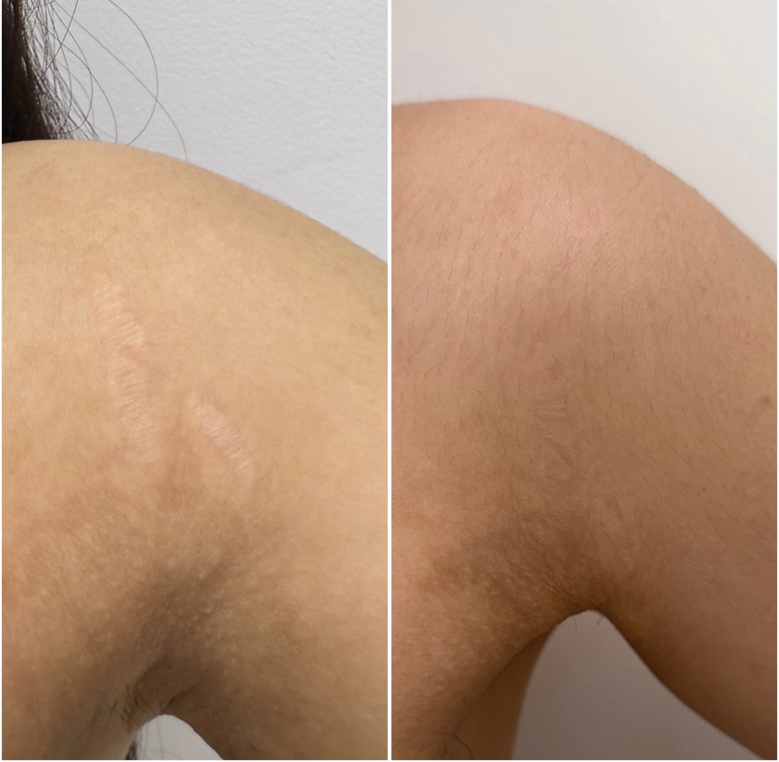 Shoulder stretch marks - Inkless Tattoo