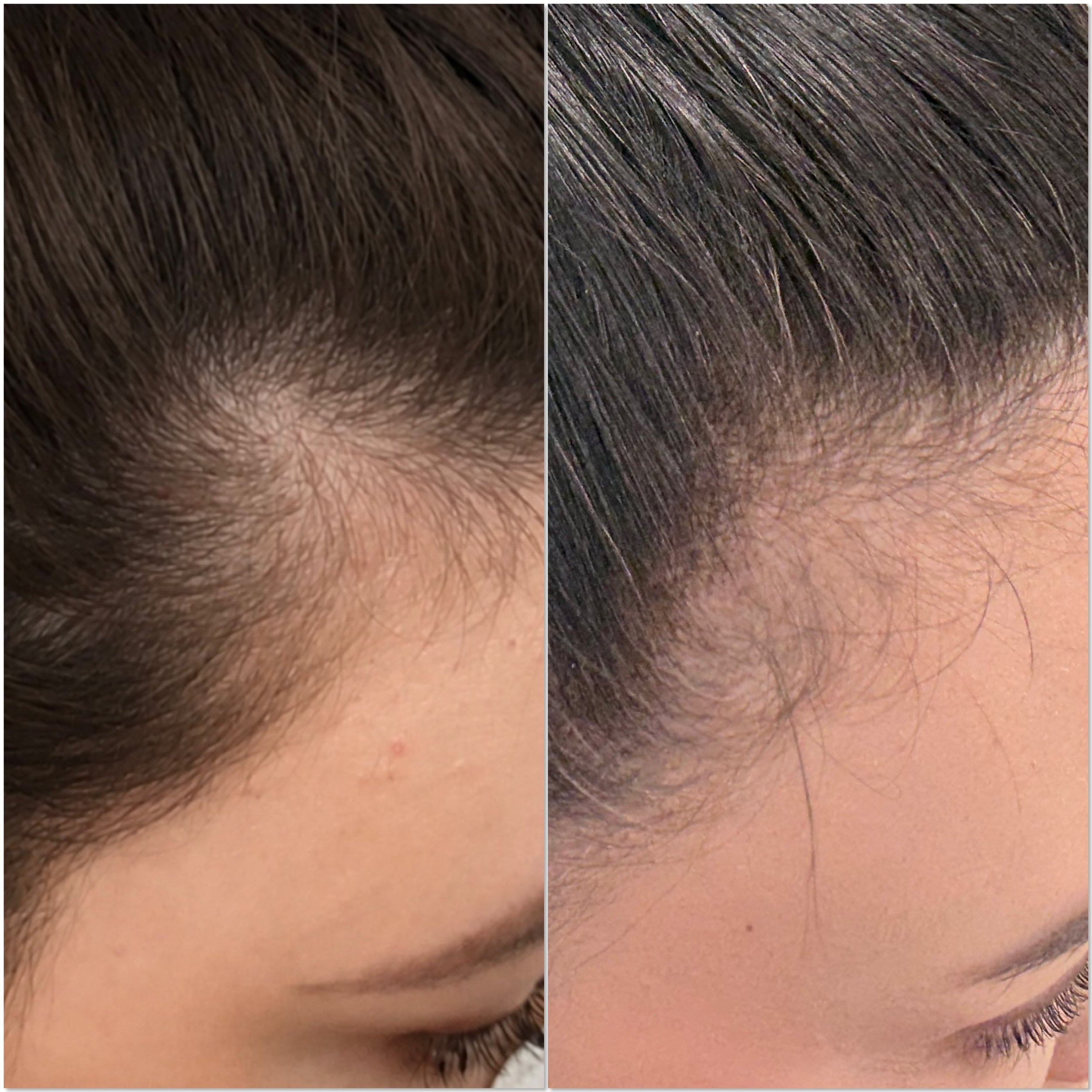 Hair Restoration Treatment