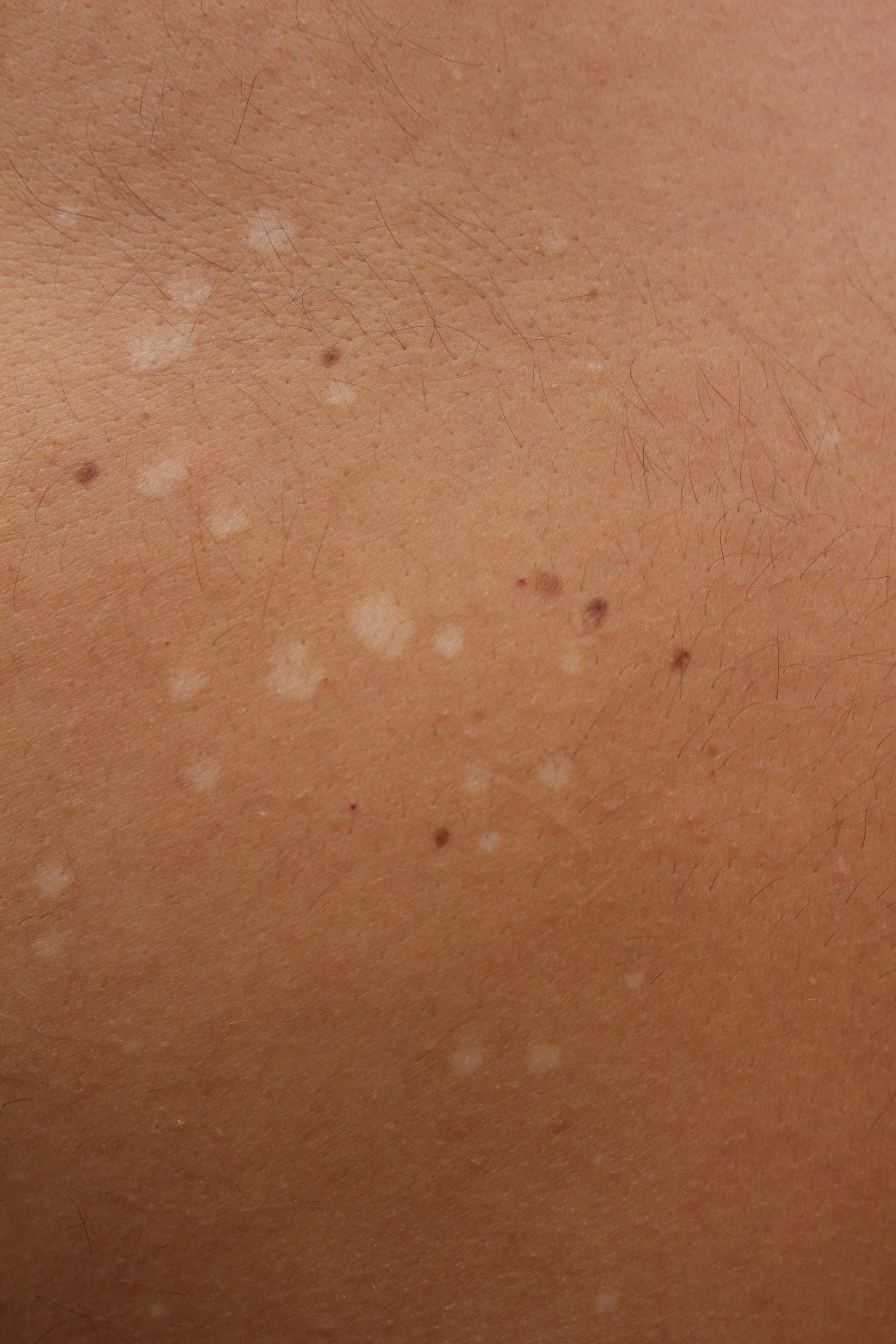 hypopigmentation on back up close .jpeg