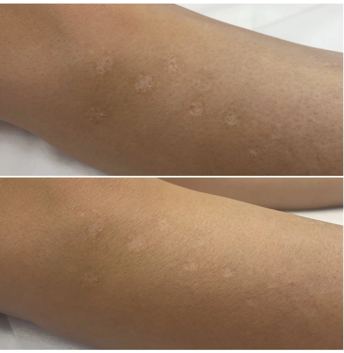 Inkless tattoo results for hypopigmented scar camouflage – Mosman clinic
Inkless tattoo procedure for white scar blending – Skin Conceal Sydney
Top inkless tattoo artist in Sydney for scar camouflage – Skin Conceal clinic