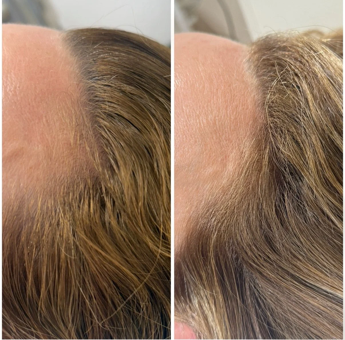 Hair Restoration Treatment