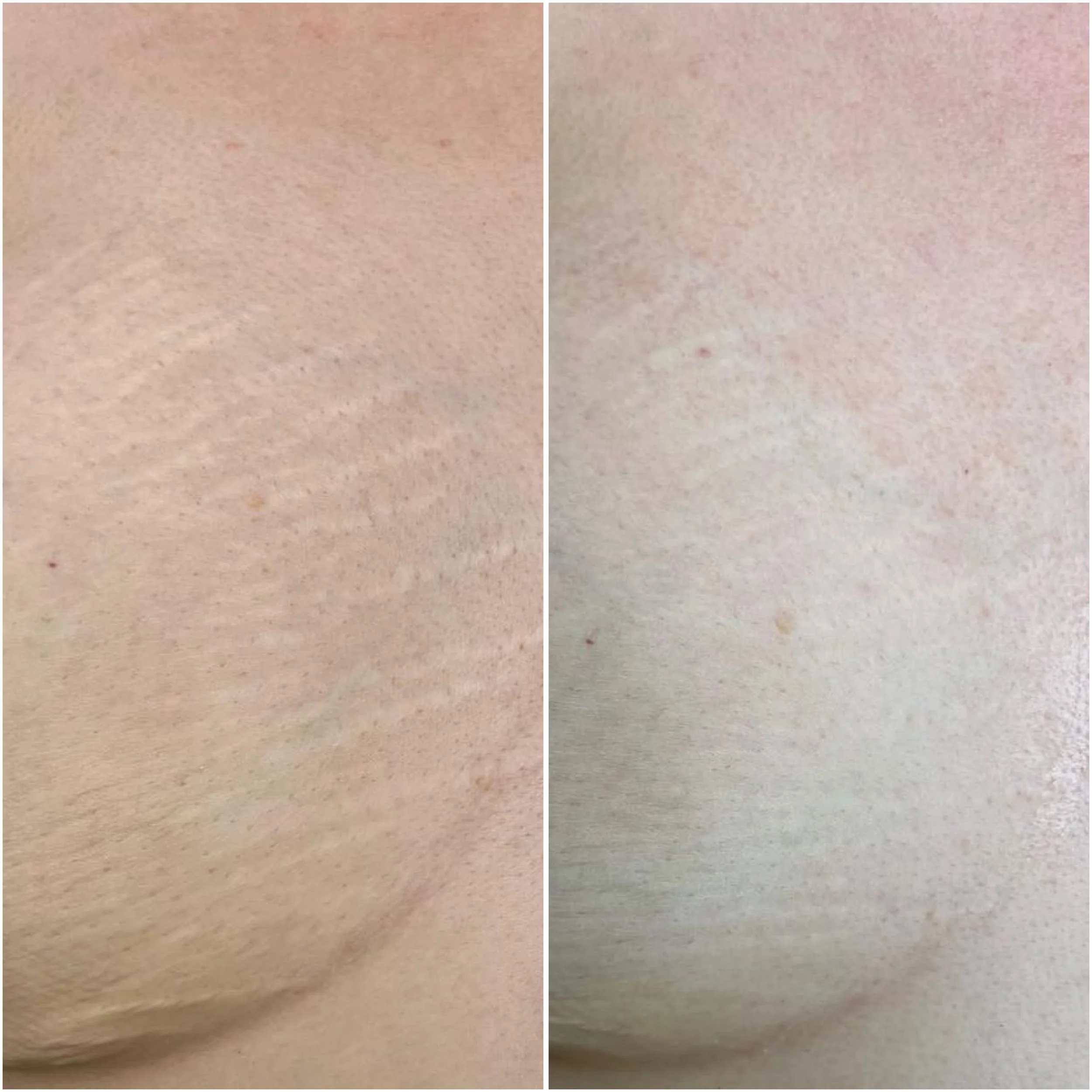 Side-by-side comparison of skin before and after treatment, showing smoother skin on the right.