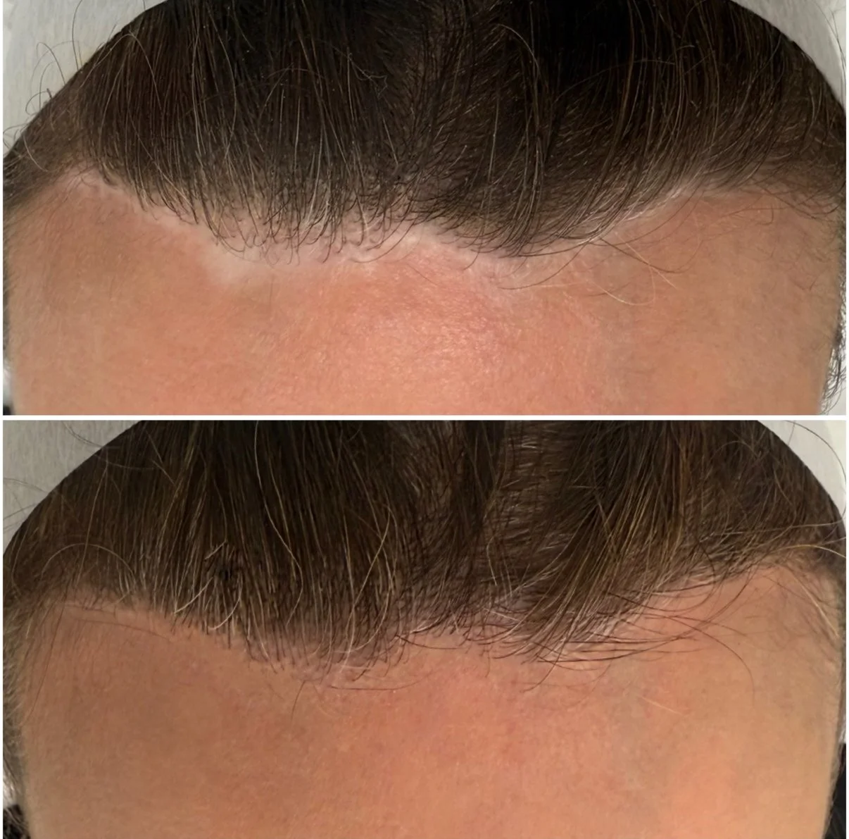 Hairline scars - Camouflage Tattoo