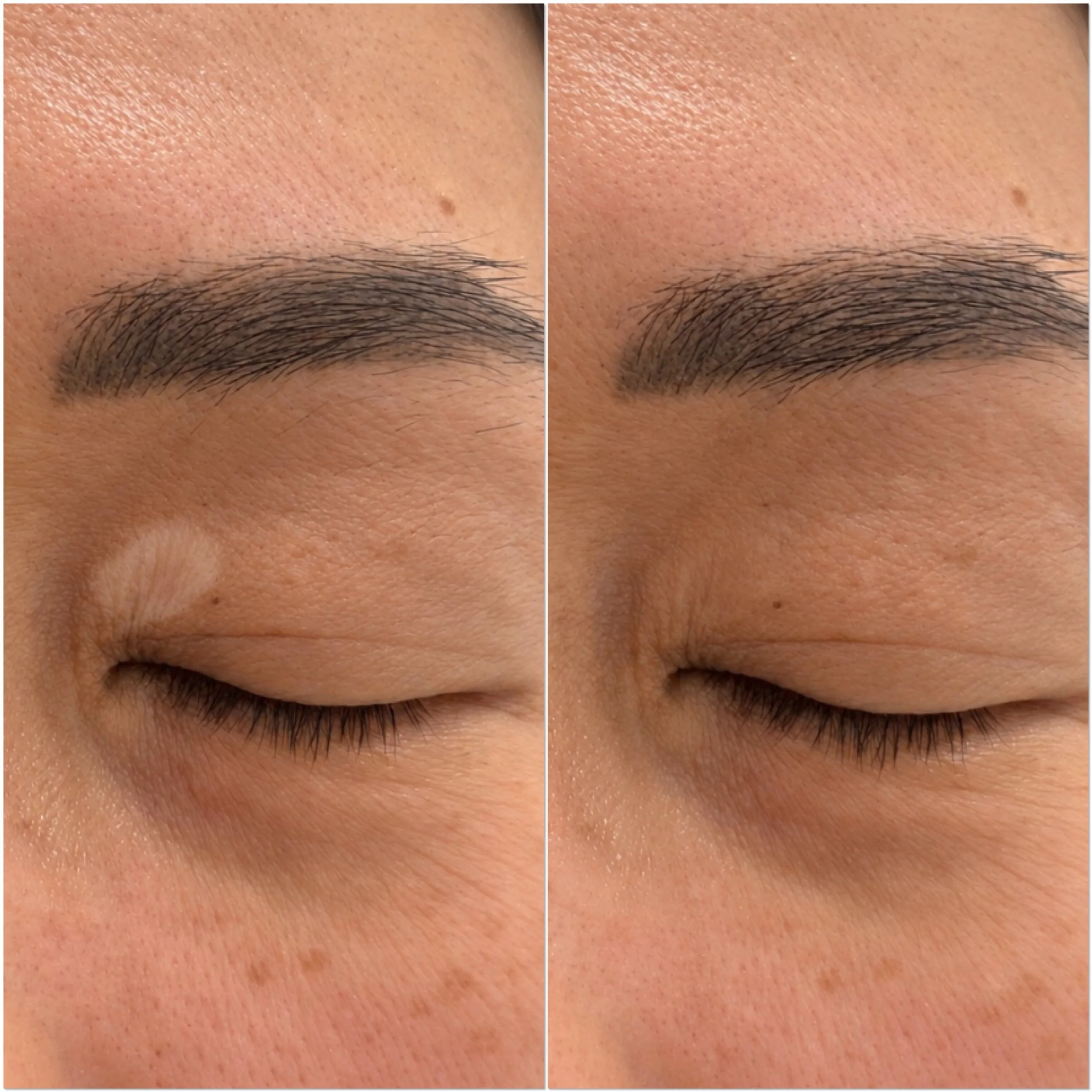 Eyelid scar - Camouflage Tattoo
