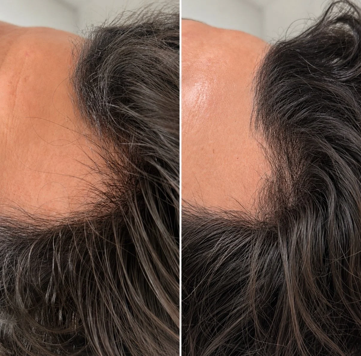 Hair Restoration Treatment