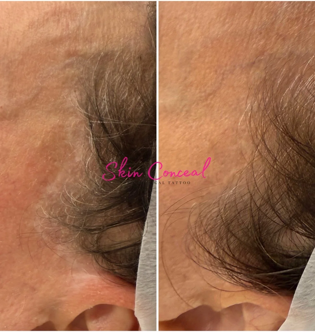 Facelift scars - Camouflage tattoo