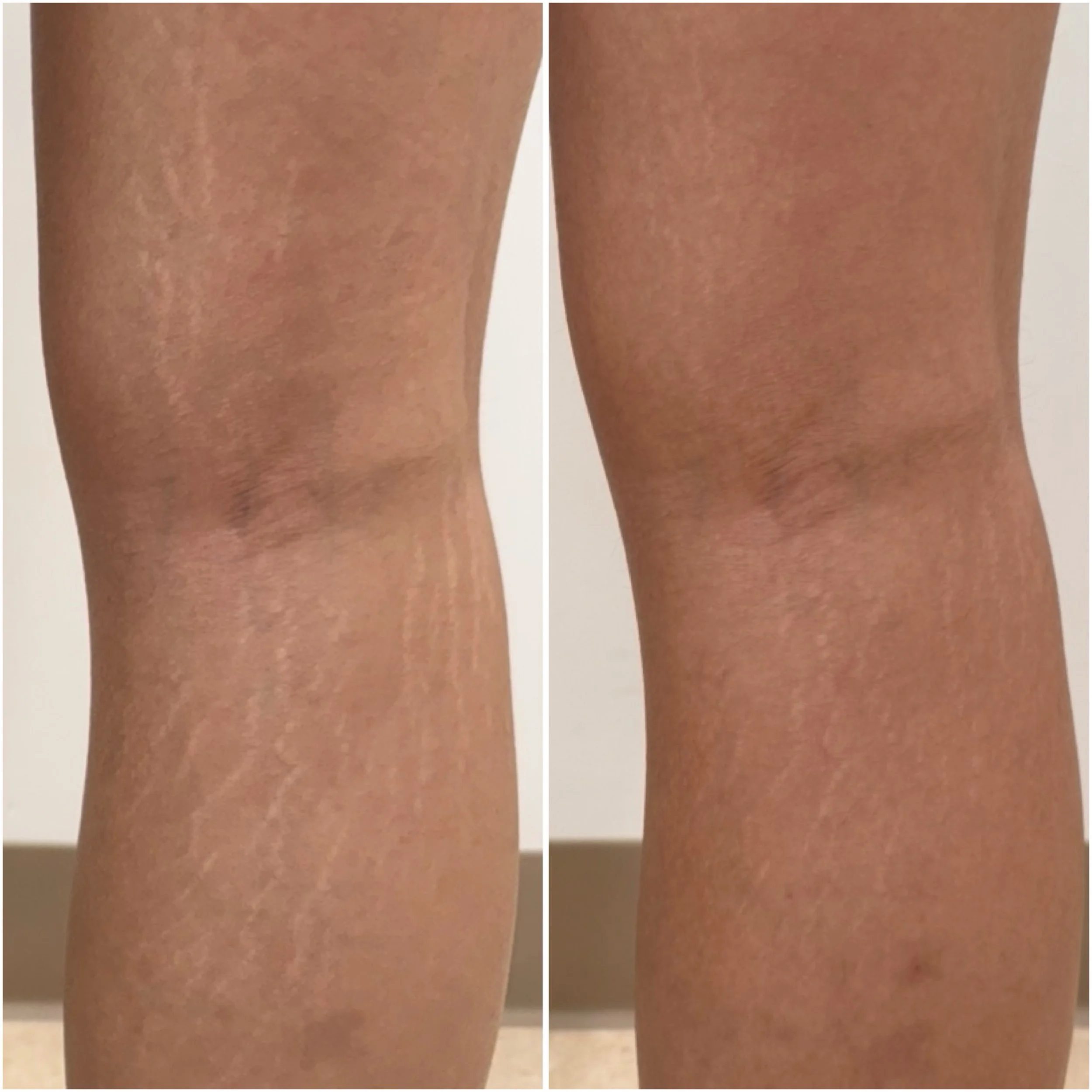 Calf stretch marks - Inkless tattoo