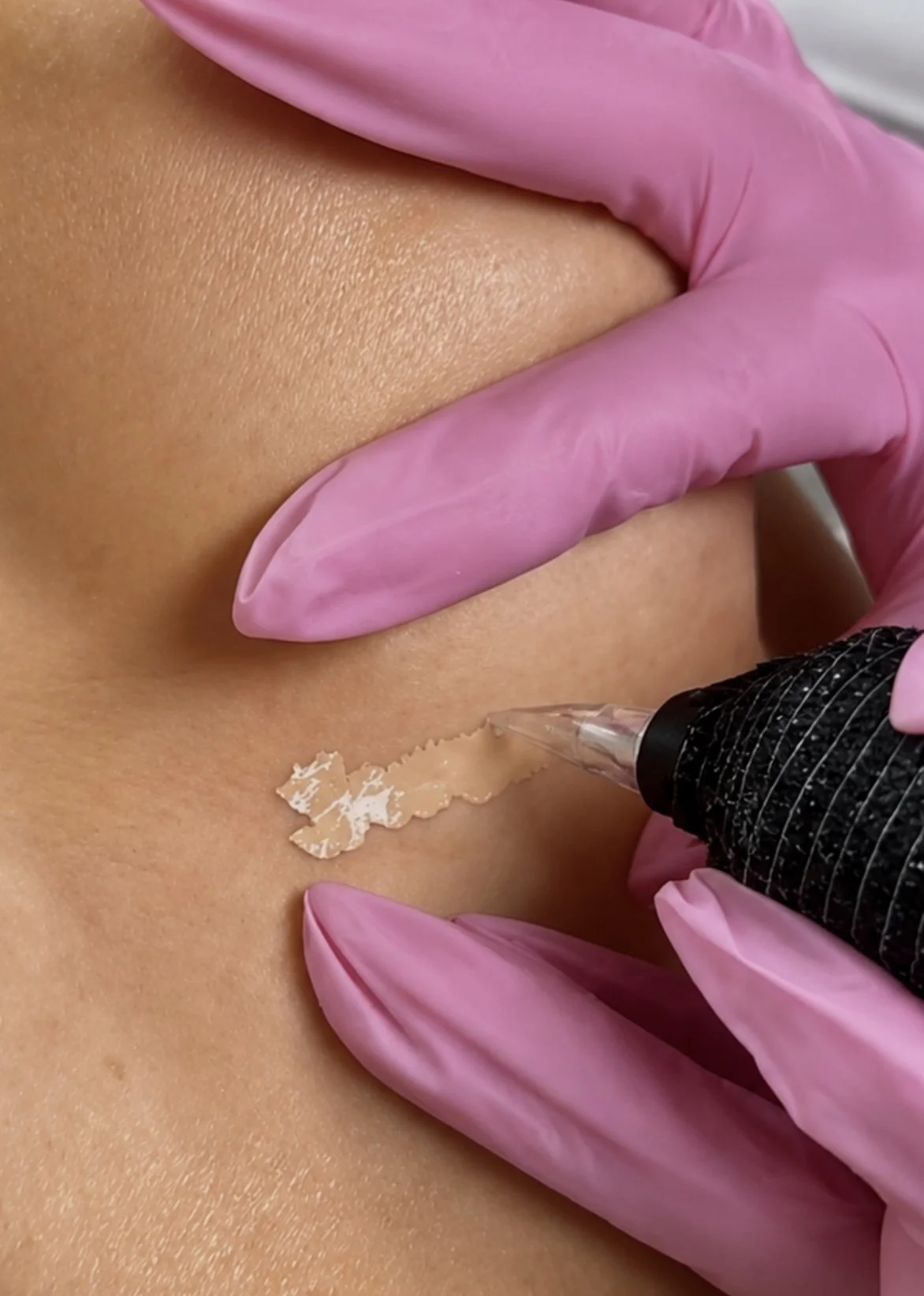 Paramedical tattoo for surgical scar concealment – Skin Conceal Sydney
breast surgery scar tattooing – Mosman Skin Conceal
Top scar camouflage tattoo artist Sydney – Skin Conceal clinic results