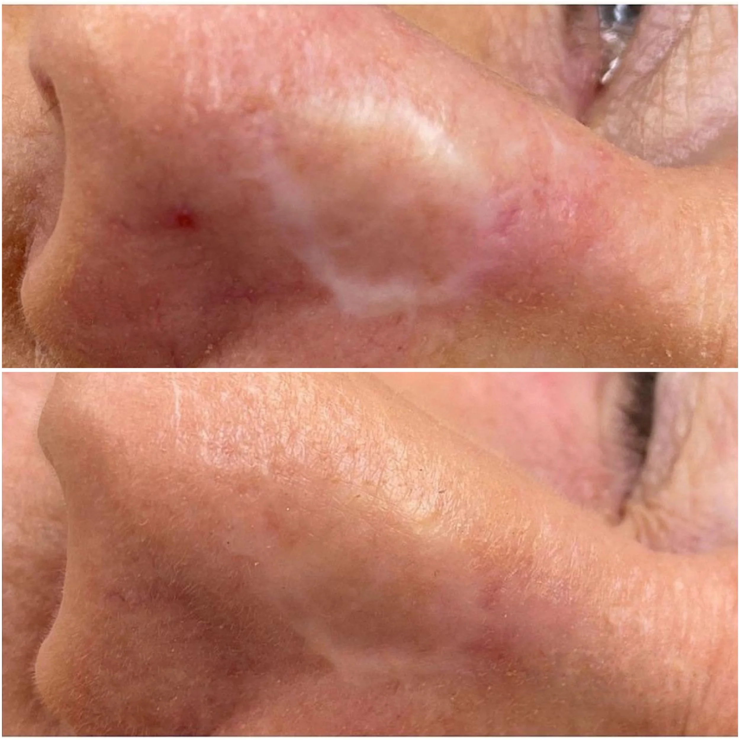 nose scar pigment.JPG