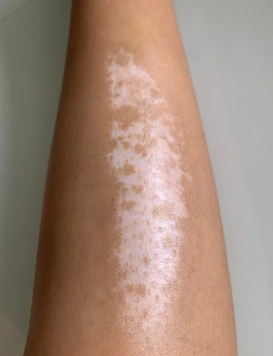 hypopigmentation on leg .jpg