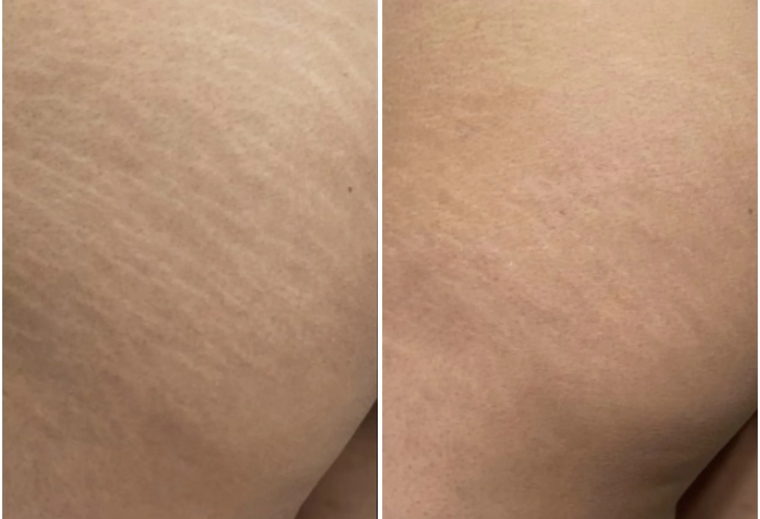 stretch mark improvement North Shore sydney
Stretch mark treatment Sydney – before and after results
Inkless tattoo results for stretch marks – Skin Conceal Mosman