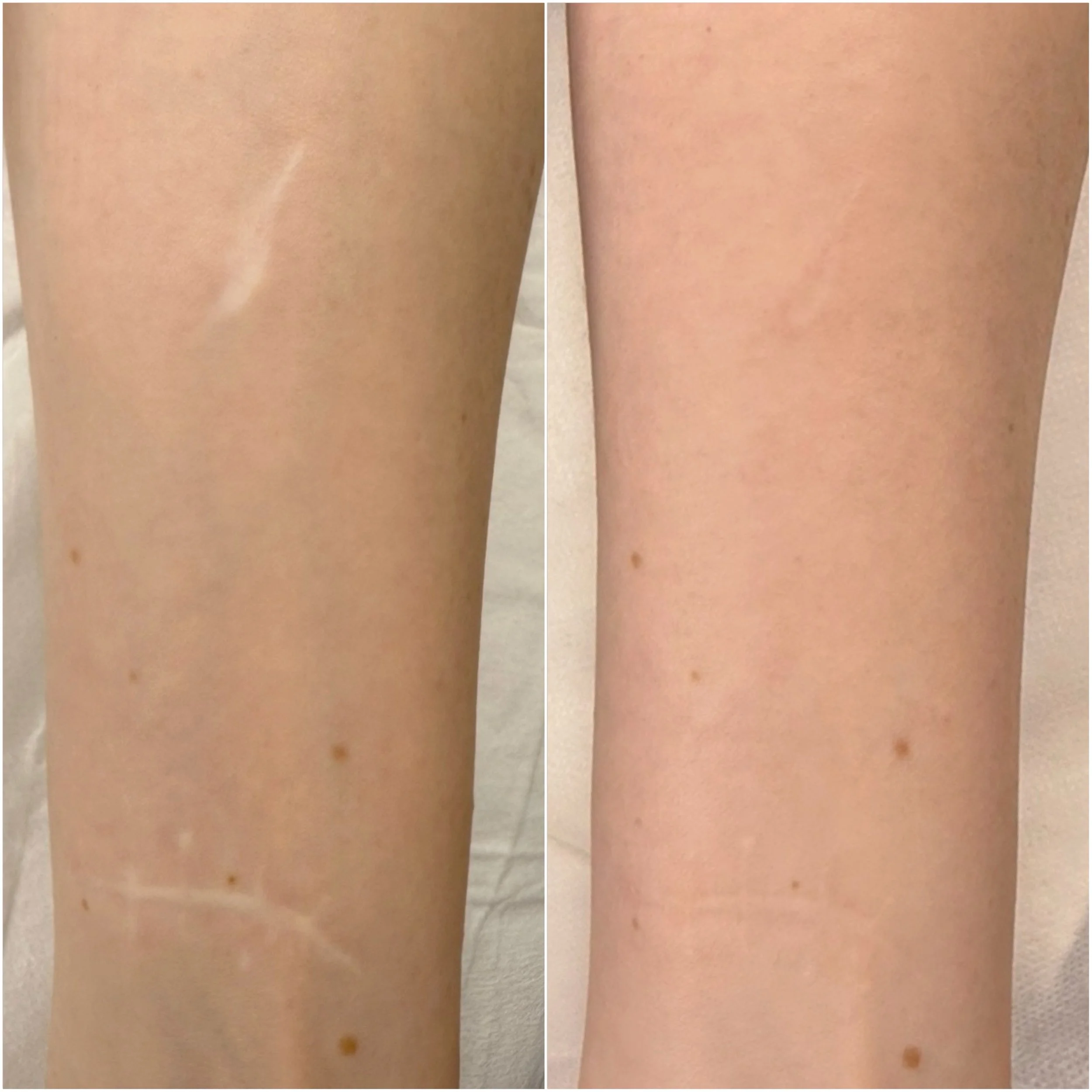 Self harm scars - Inkless + Camouflage Tattoo