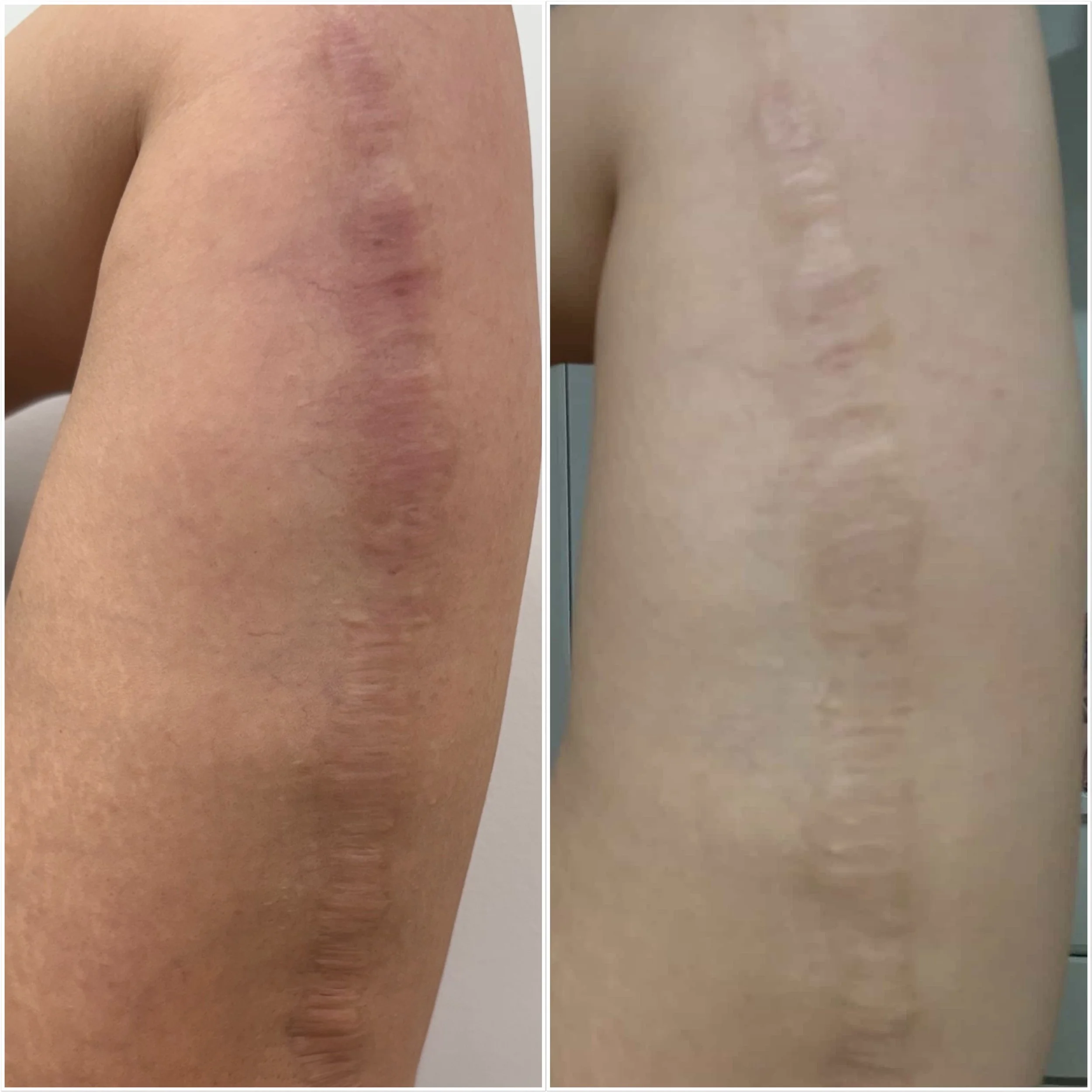 Arm lift Scars - Inkless Tattoo