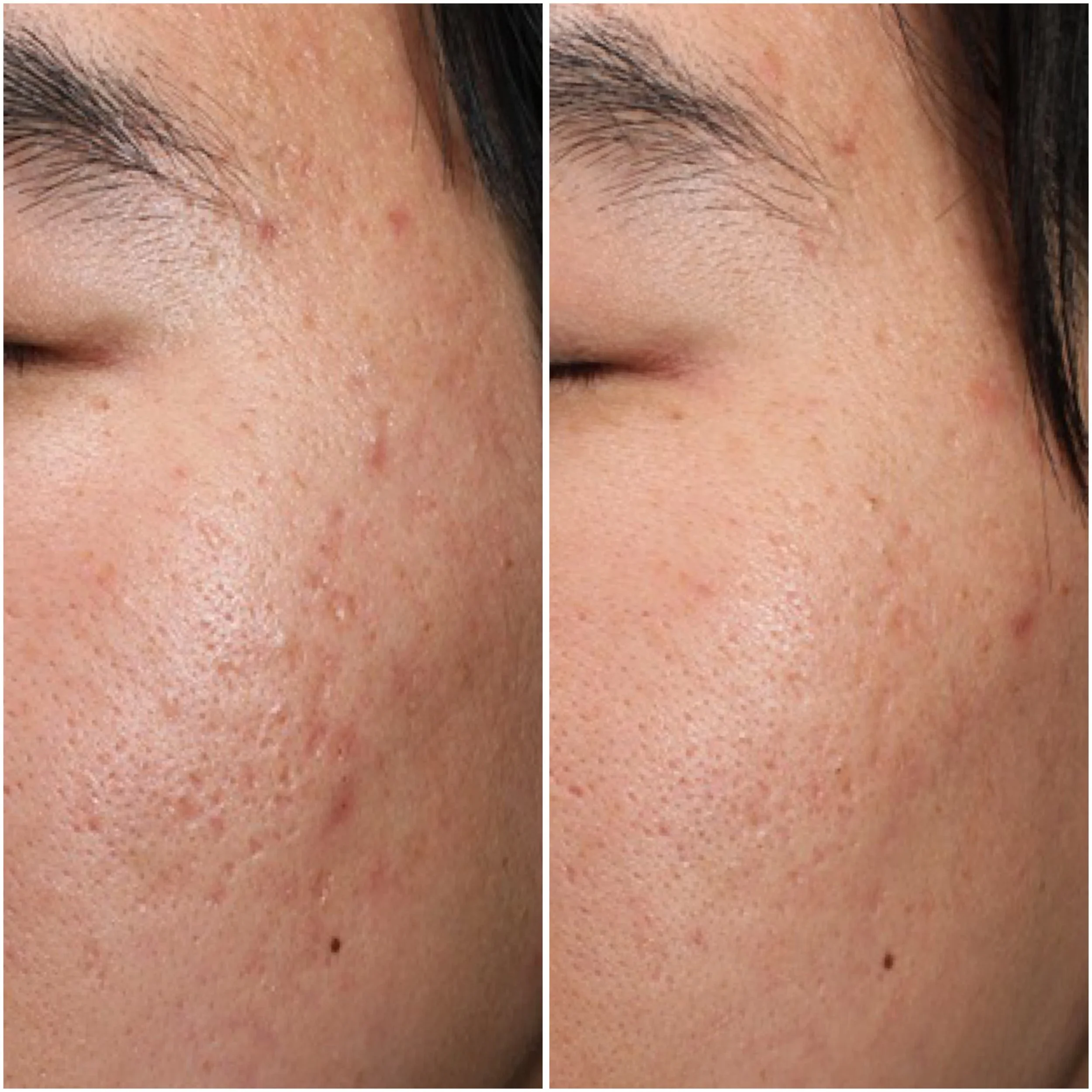 Acne scars - Inkless tattoo 