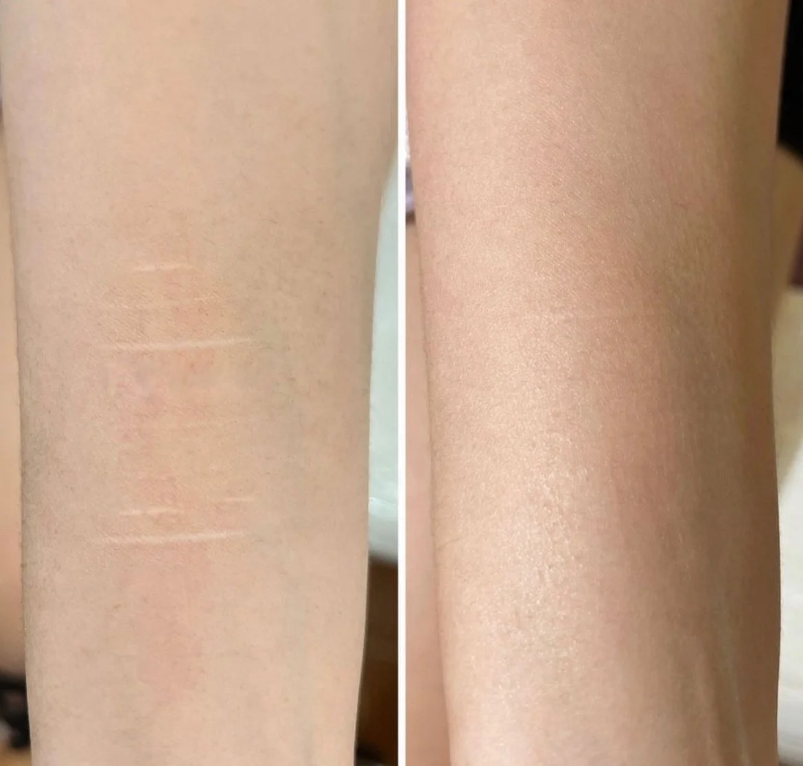 SH scars pigment 1.JPG