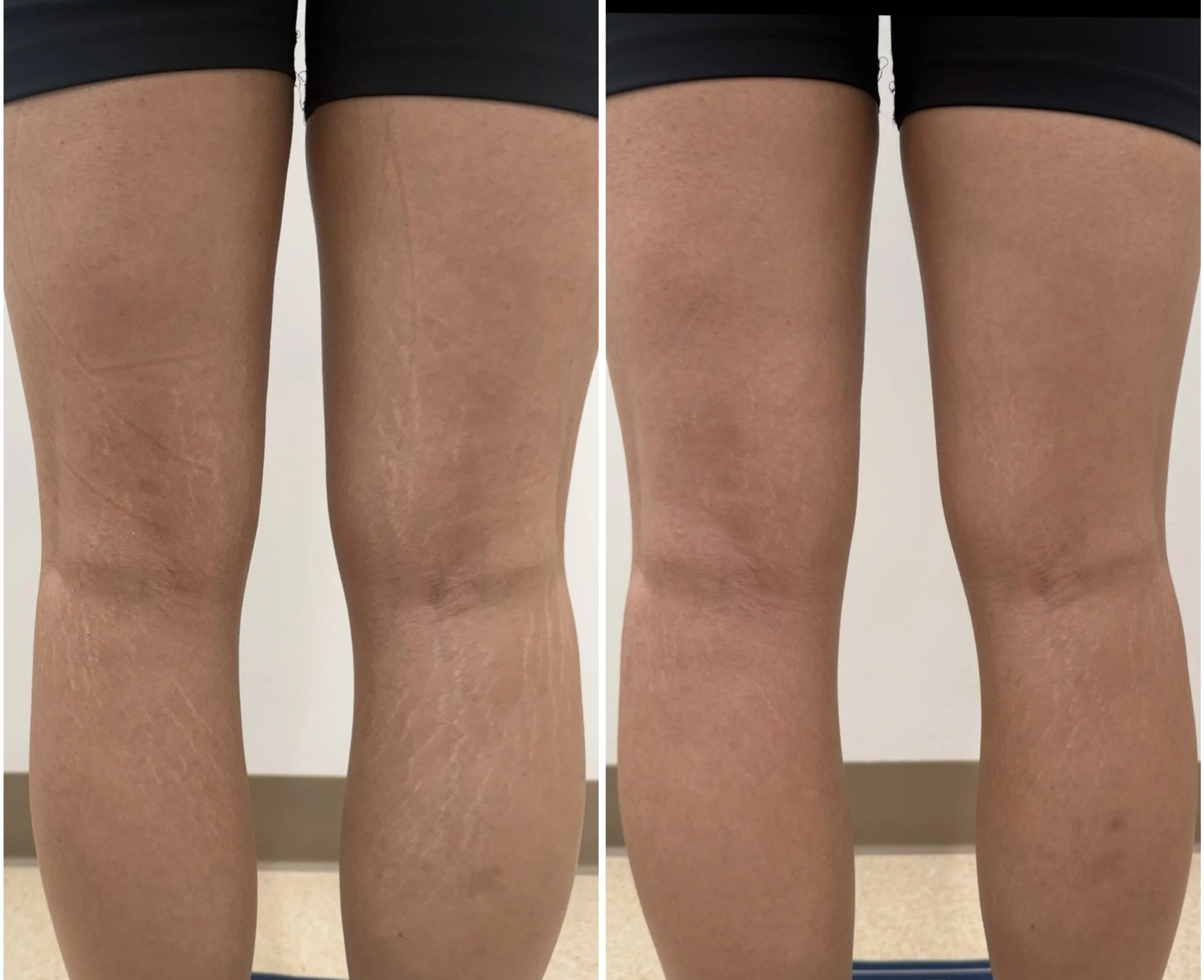 Leg stretch marks - Inkless tattoo