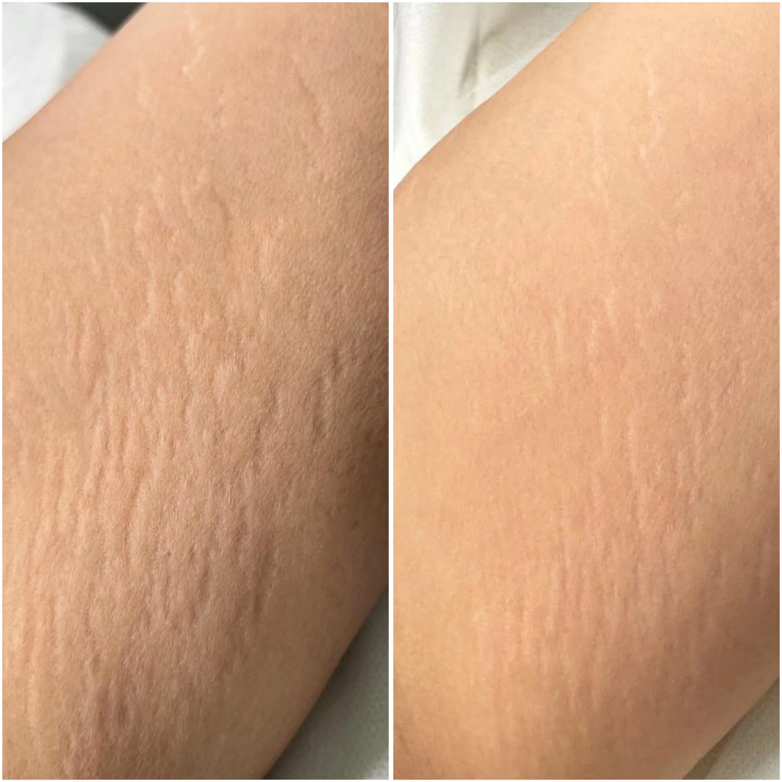Before and after inkless tattoo for stretch marks on thighs – North Shore Sydney
Treatment for stretch marks skin needling sydney
Best medical tattoo results for scar and stretch mark concealment – Skin Conceal Sydney