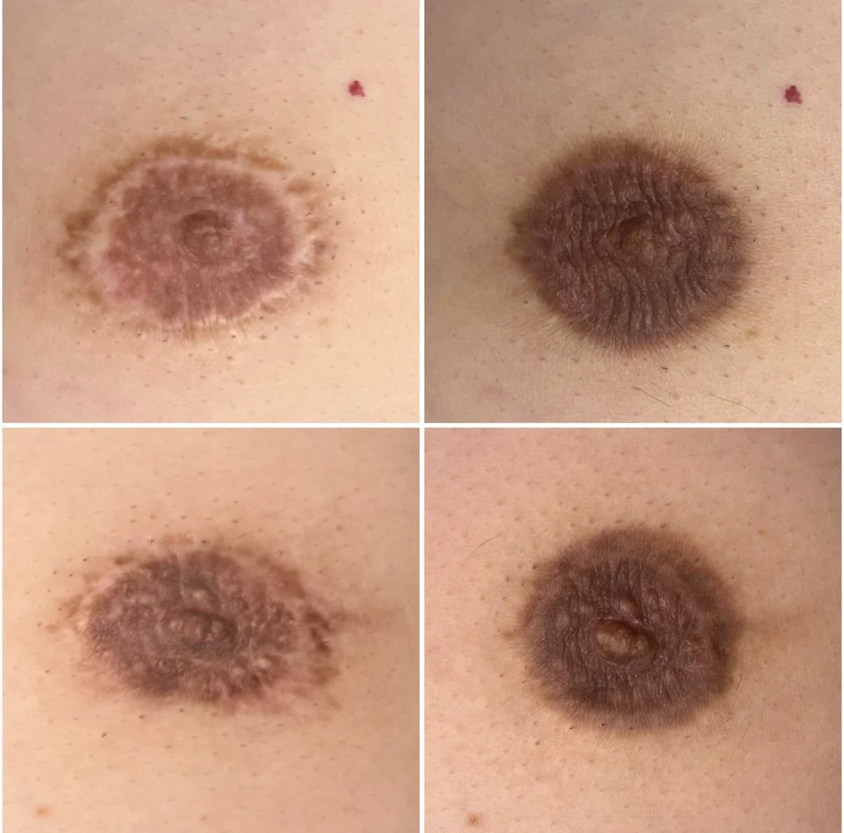 Areola Scars - Camouflage Tattoo