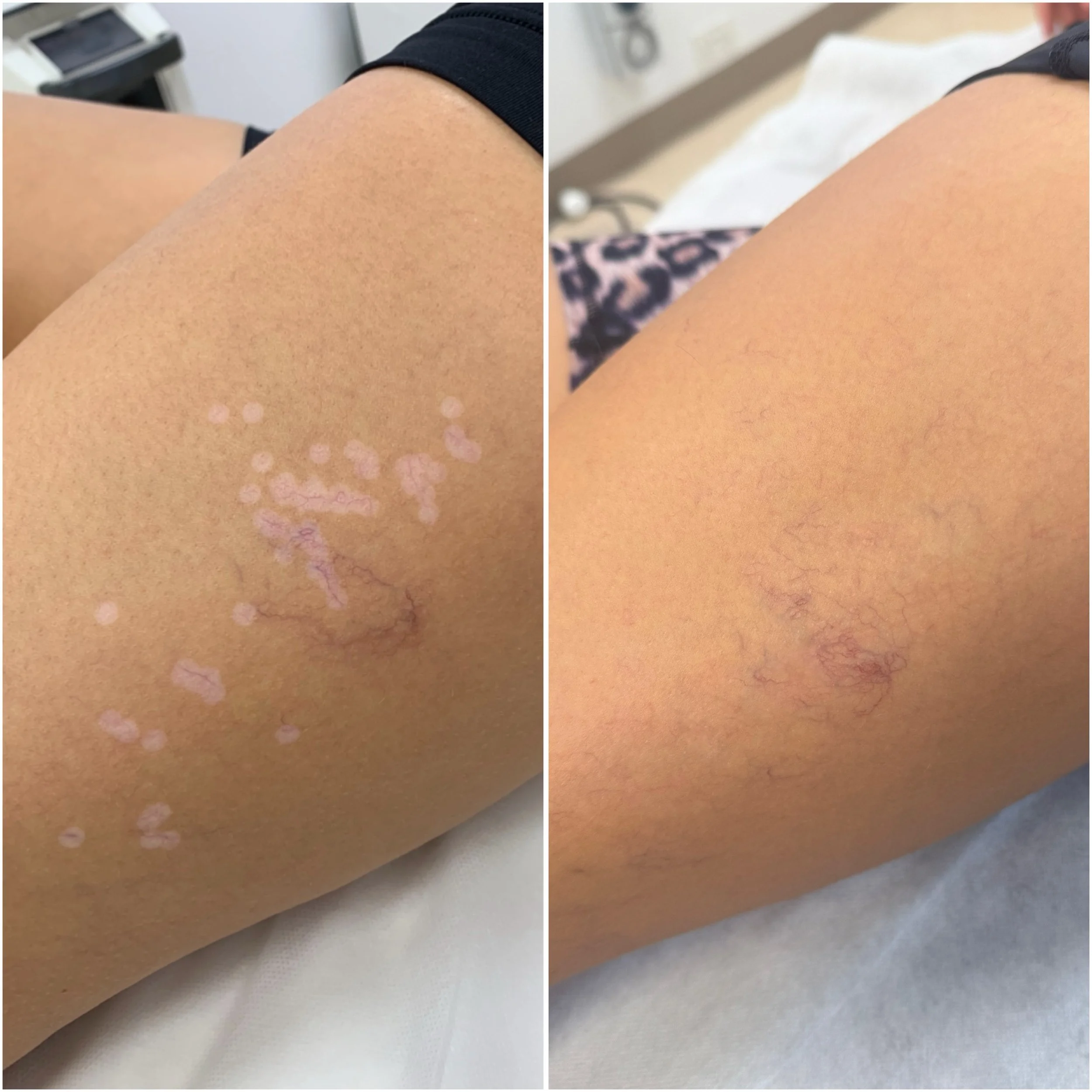 Leg hypopigmentation - Inkless tattoo