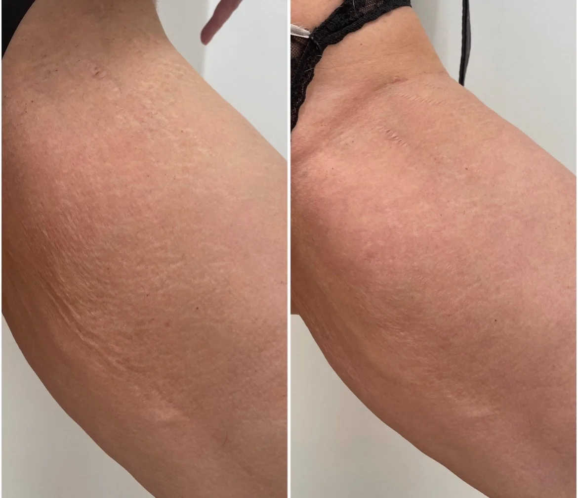 Comparison of a thigh with rough, dry skin on the left and smoother, moisturized skin on the right.
