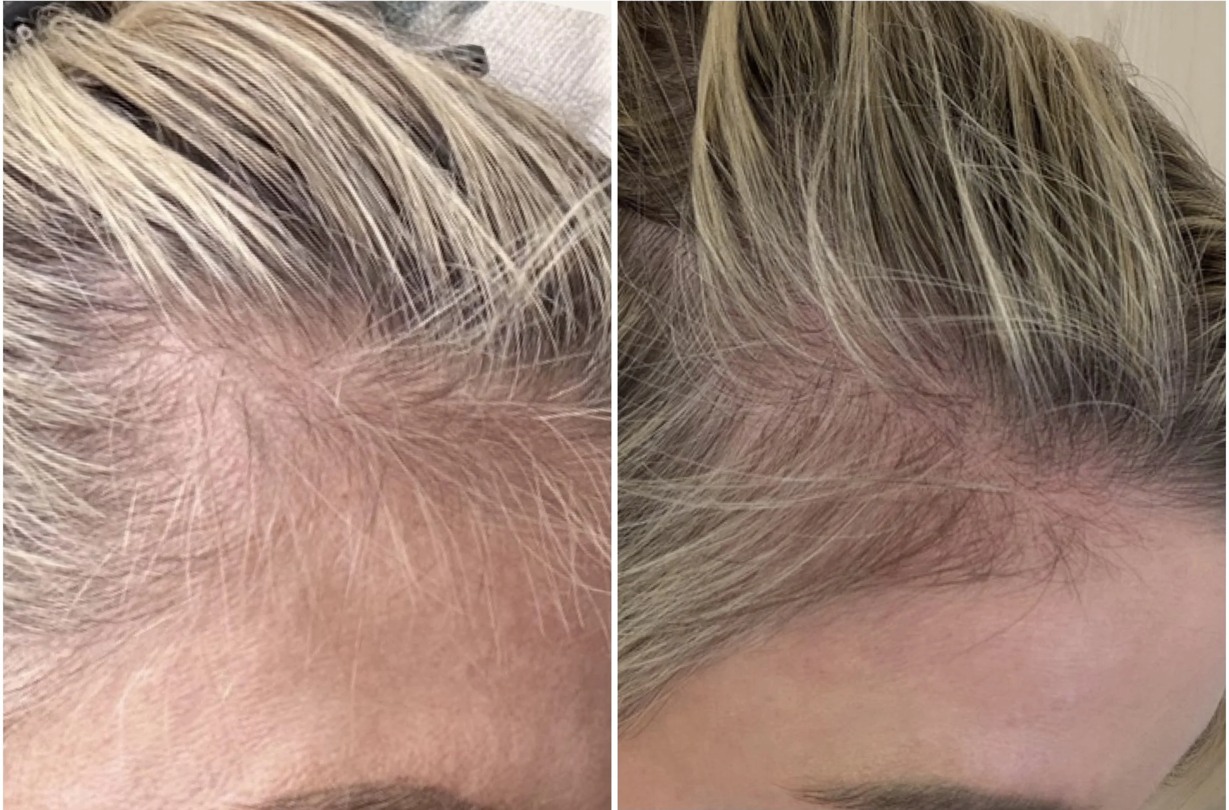 Hair Restoration Treatment 
