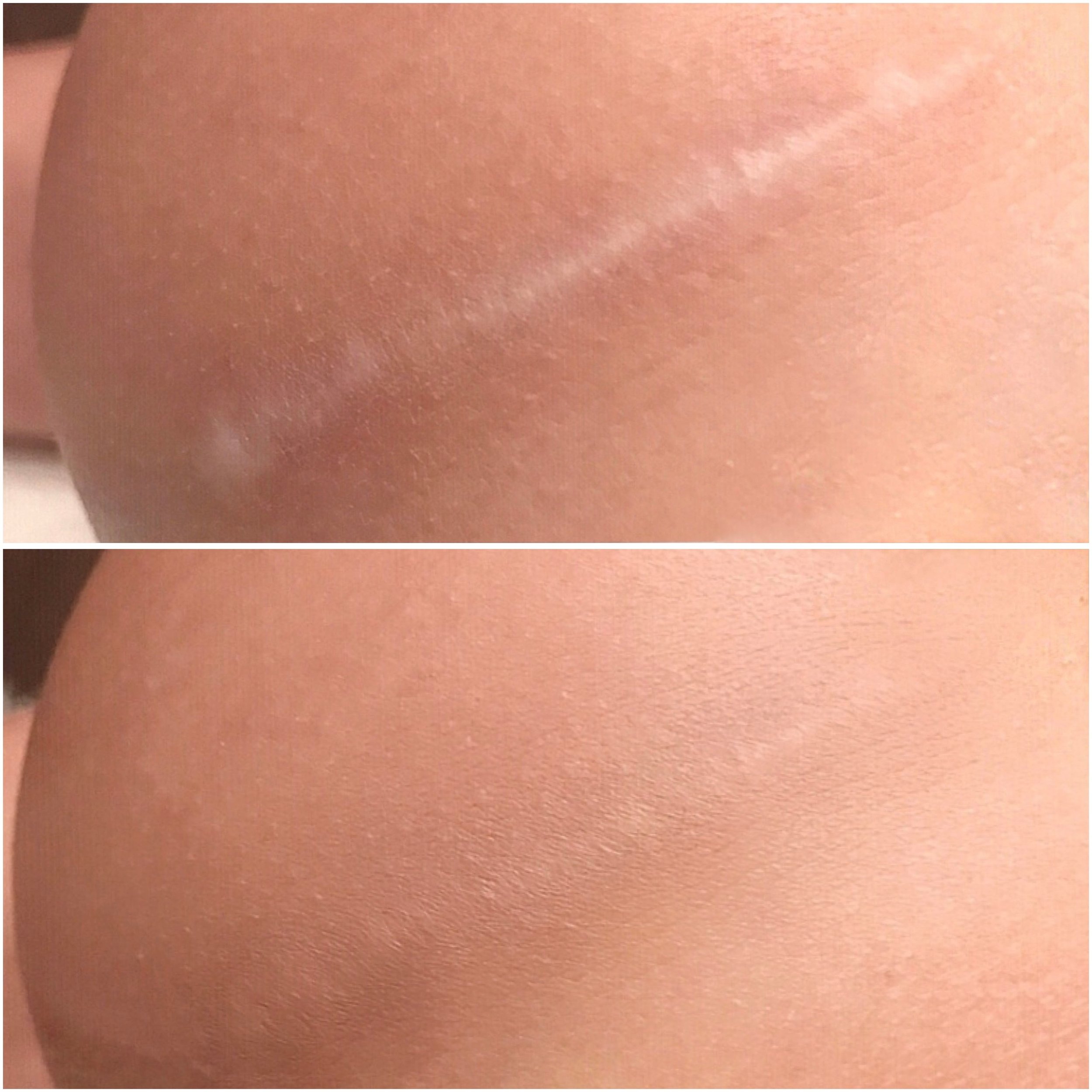 A comparison of two close-up images of skin, showing a before and after treatment. The top image shows skin with some scars and uneven texture, while the bottom image shows smoother and clearer skin.