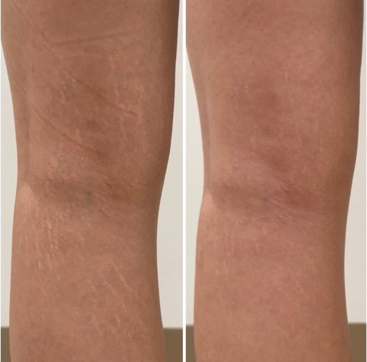 Calf stretch marks - Inkless tattoo