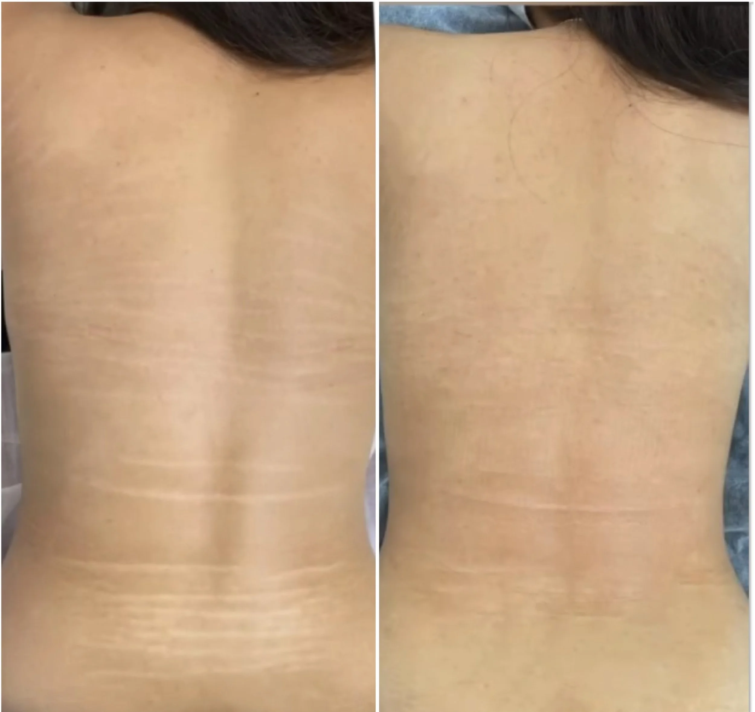 Comparison of a person's back showing reduction in stretch marks before and after treatment.