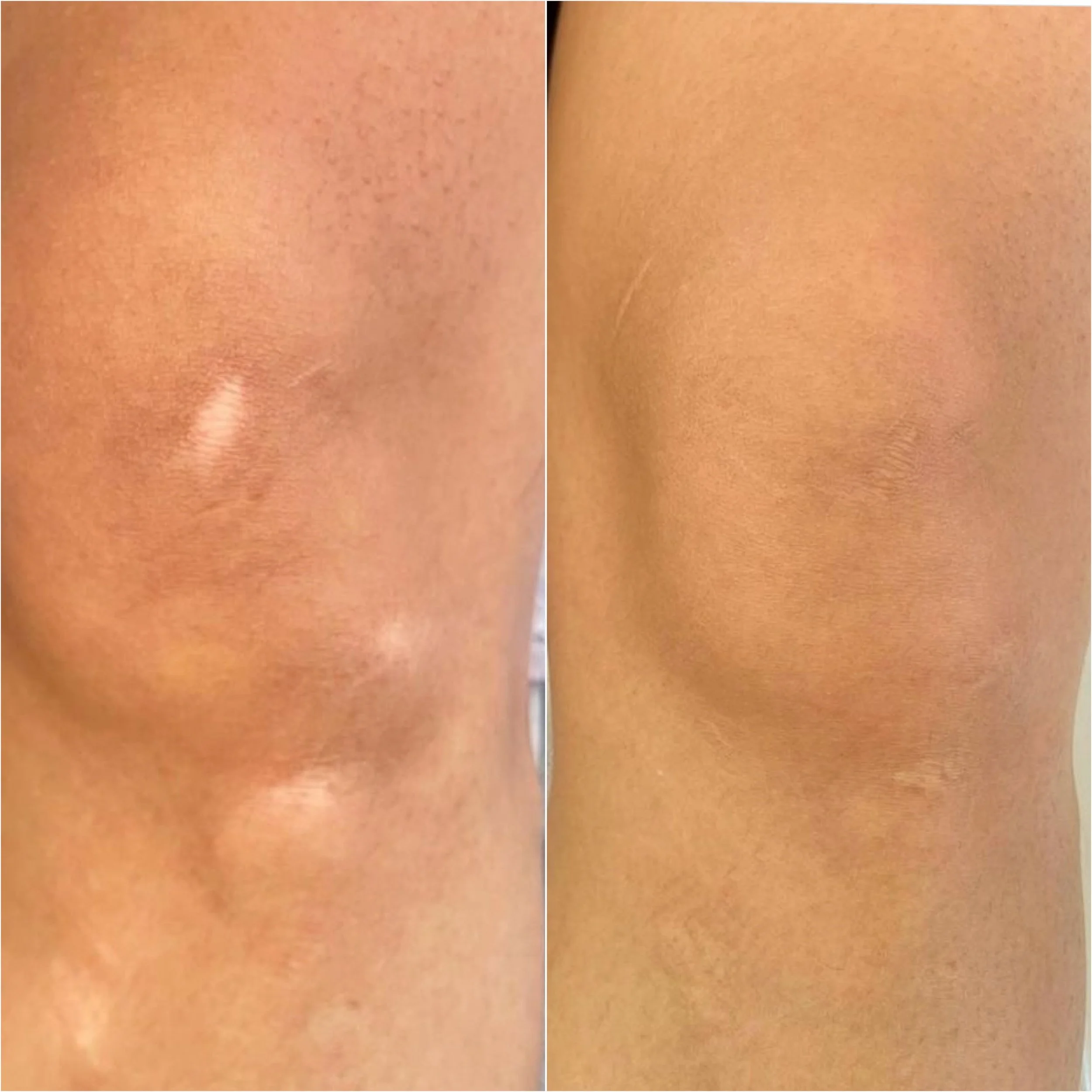Close-up of a person's knee before and after treatment, showing improved skin texture.
