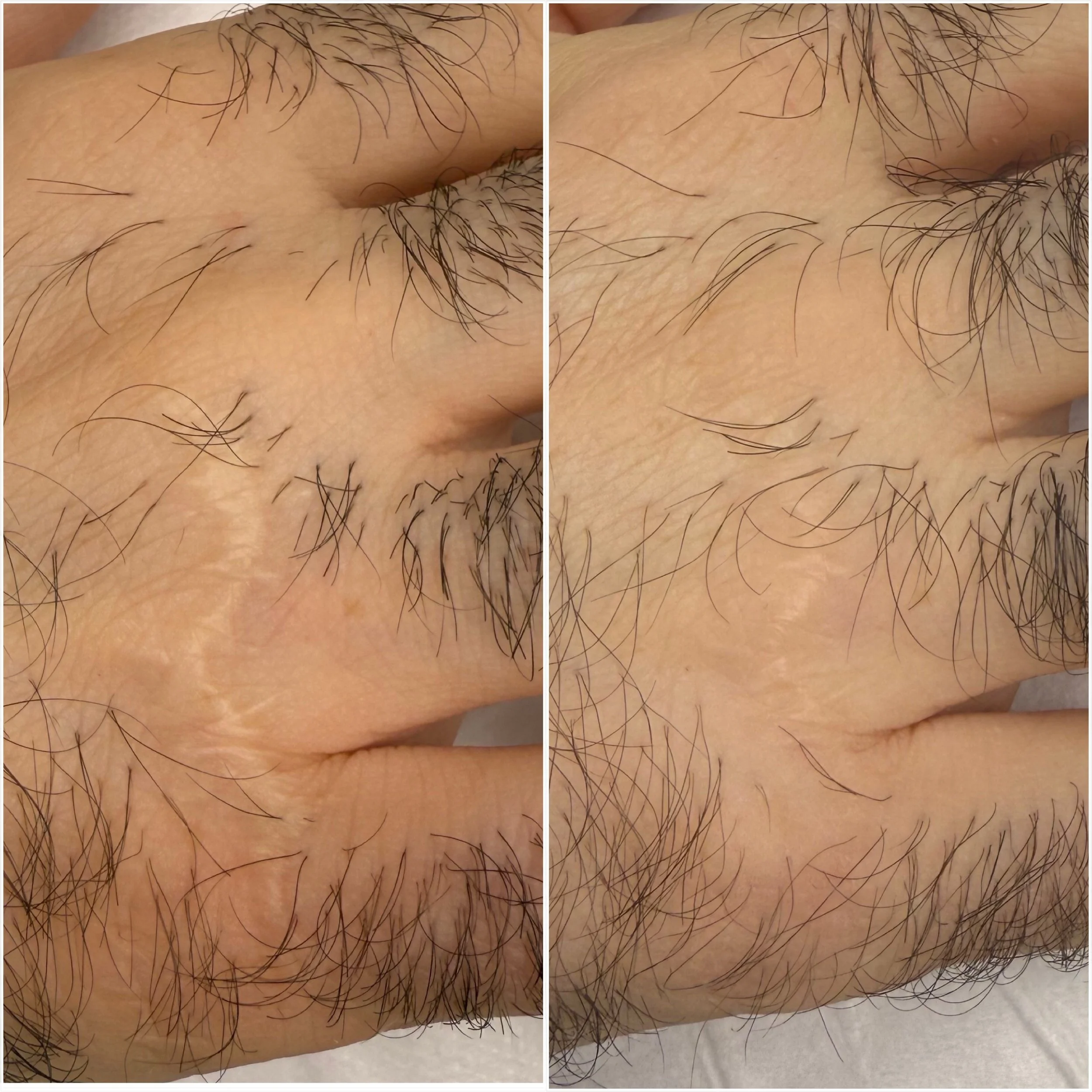 Hand scar - Inkless tattoo