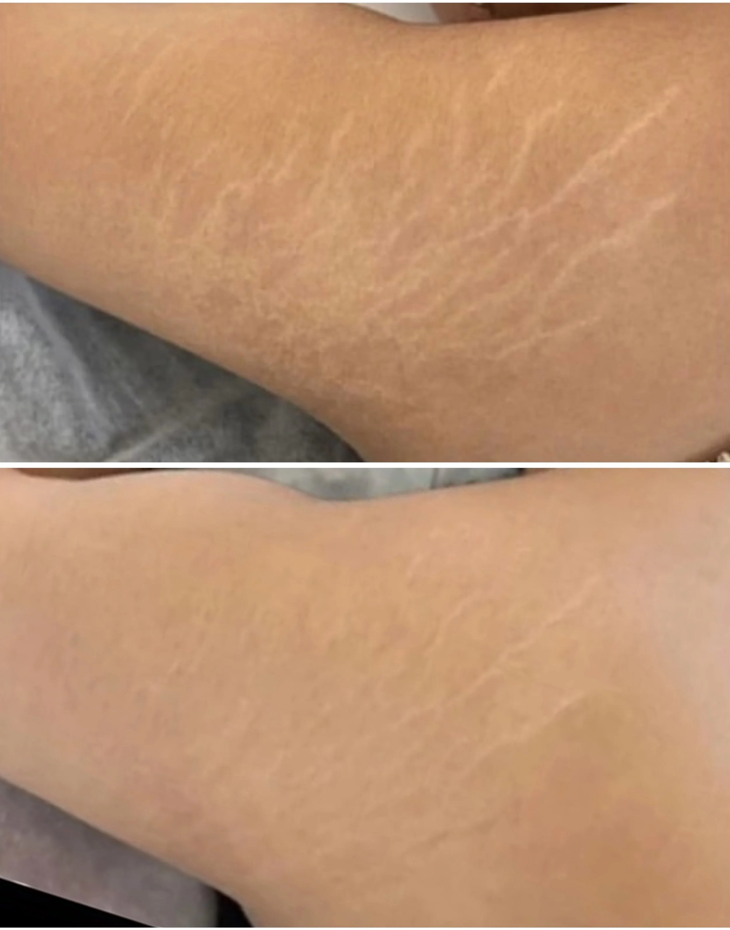 Before and after inkless tattoo for scars and stretch marks – Skin Conceal Mosman Sydney
Best camouflage tattoo for stretch marks – Skin Conceal Sydney
Best medical tattoo results for scar and stretch mark concealment – Skin Conceal Sydney