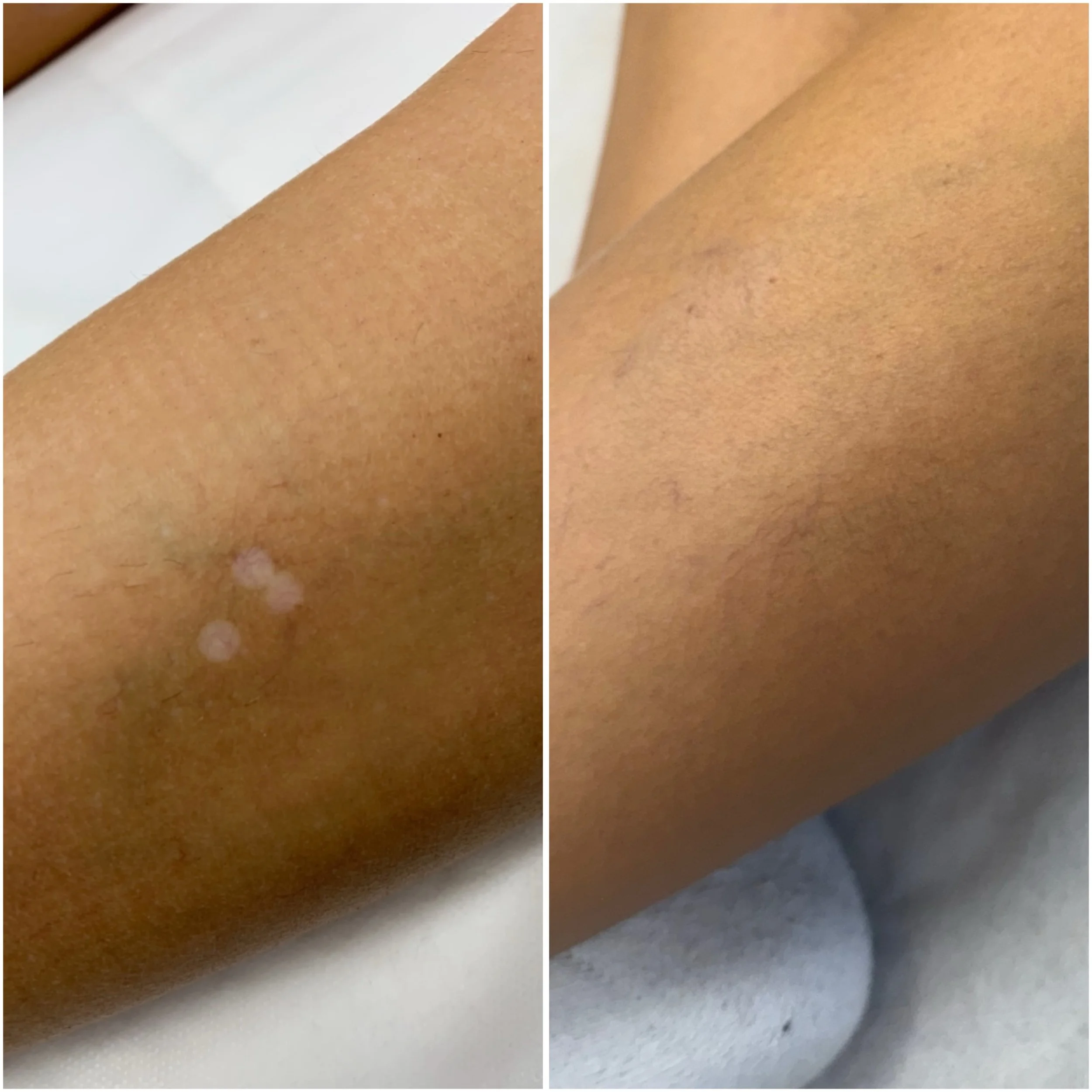 Leg hypopigmentation - Inkless tattoo