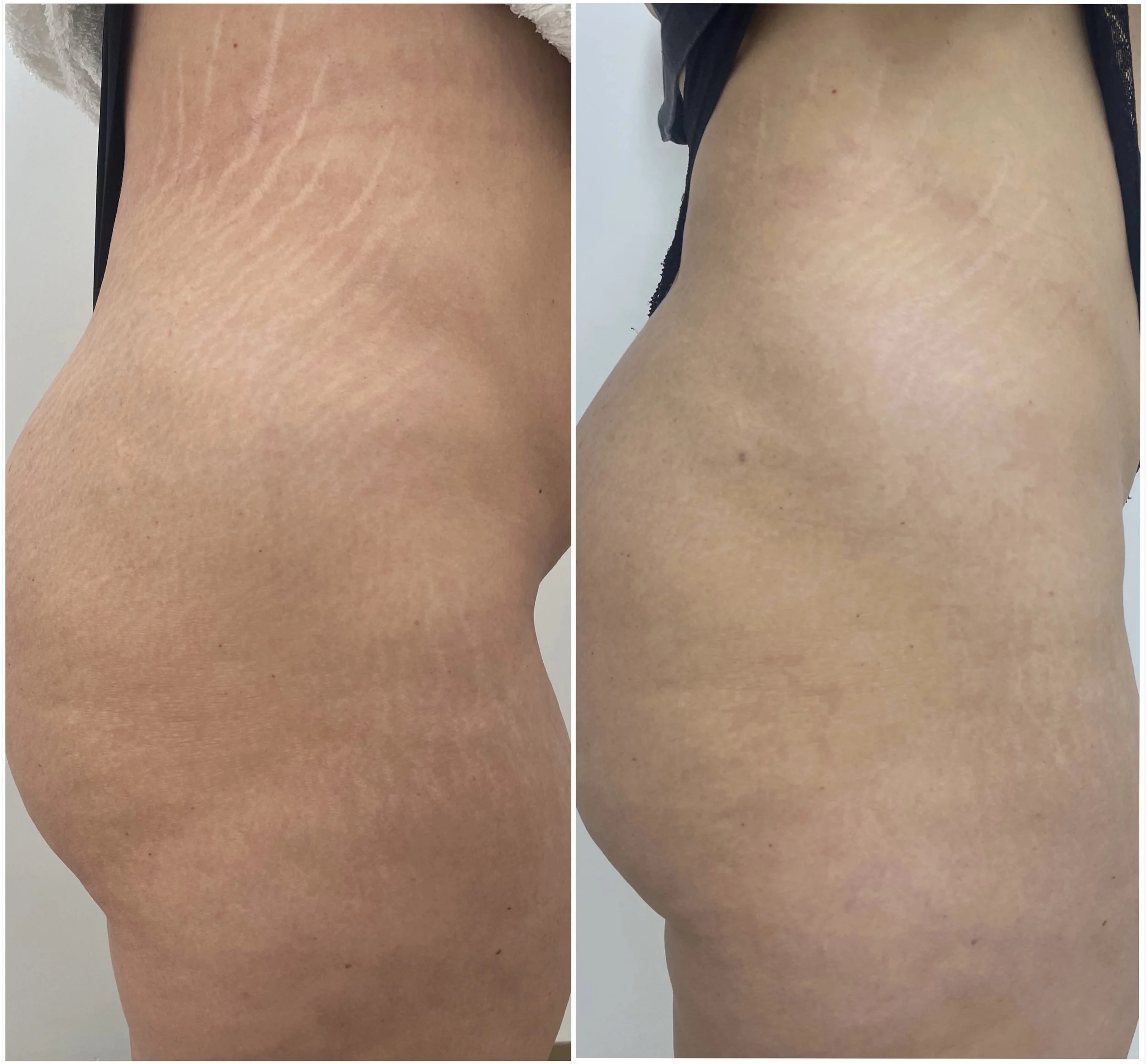 Comparison of skin texture on a person's buttocks before and after treatment, showing improvement in skin smoothness and reduction of stretch marks.