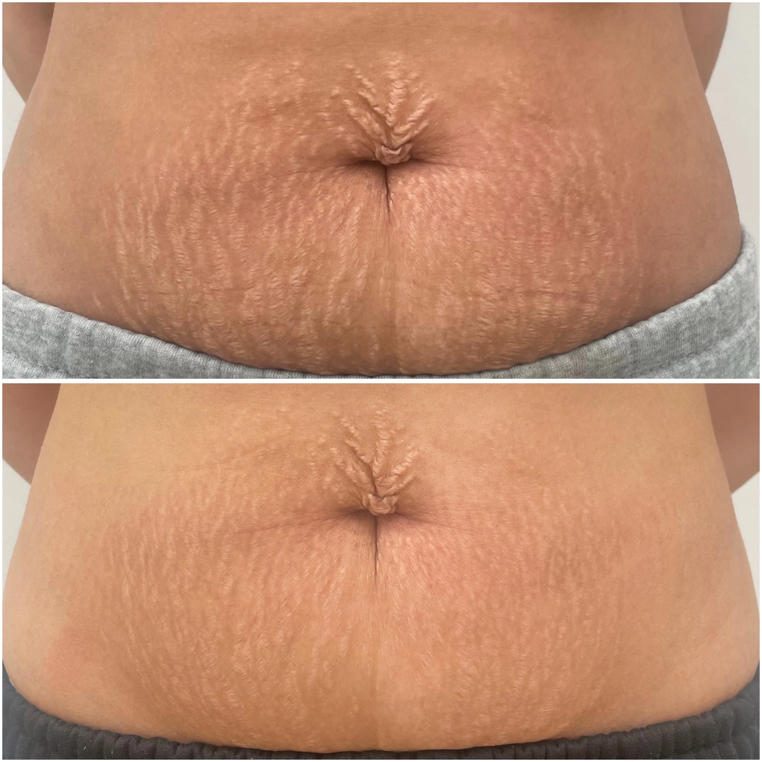 Comparison of a belly with and without stretch marks. The top image shows more prominent stretch marks, while the bottom image shows smoother skin.