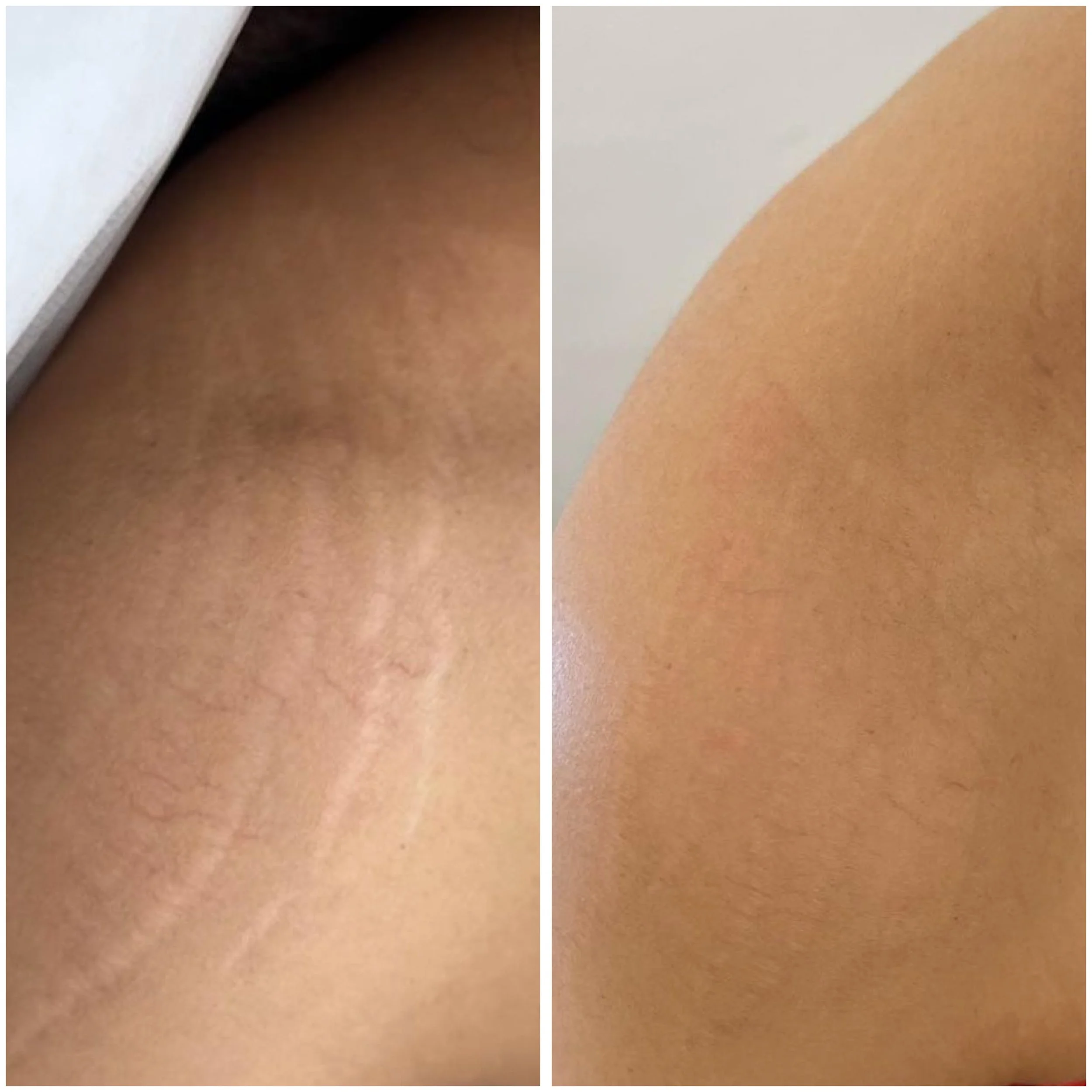 shoulder SM inkless 1.JPG