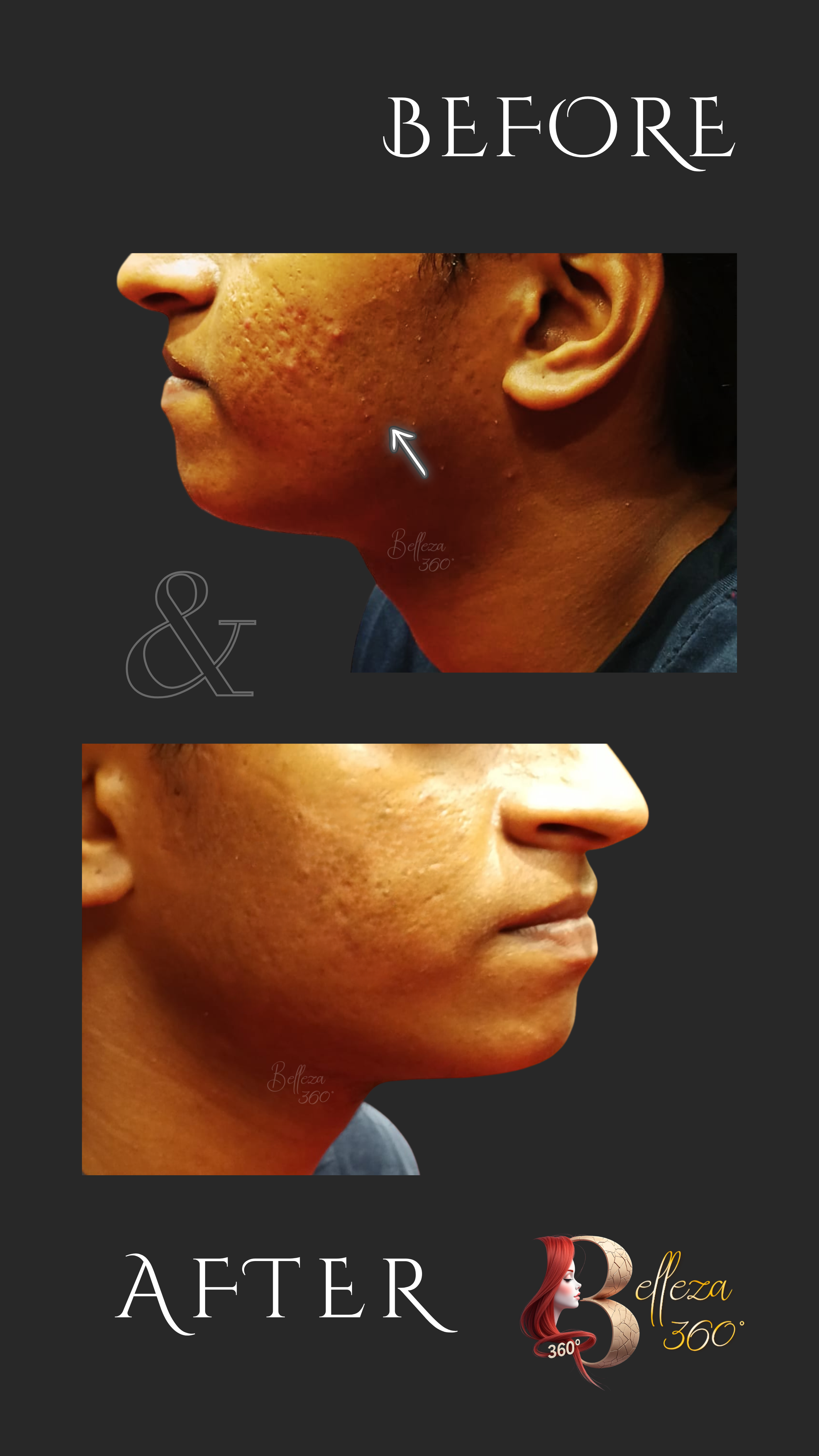 Black Peel treatment Chennai, Active acne treatment Chennai, Acne scar reduction Chennai, Skin exfoliation Chennai, Pimple removal peel Chennai, Best skin clinic in Chennai