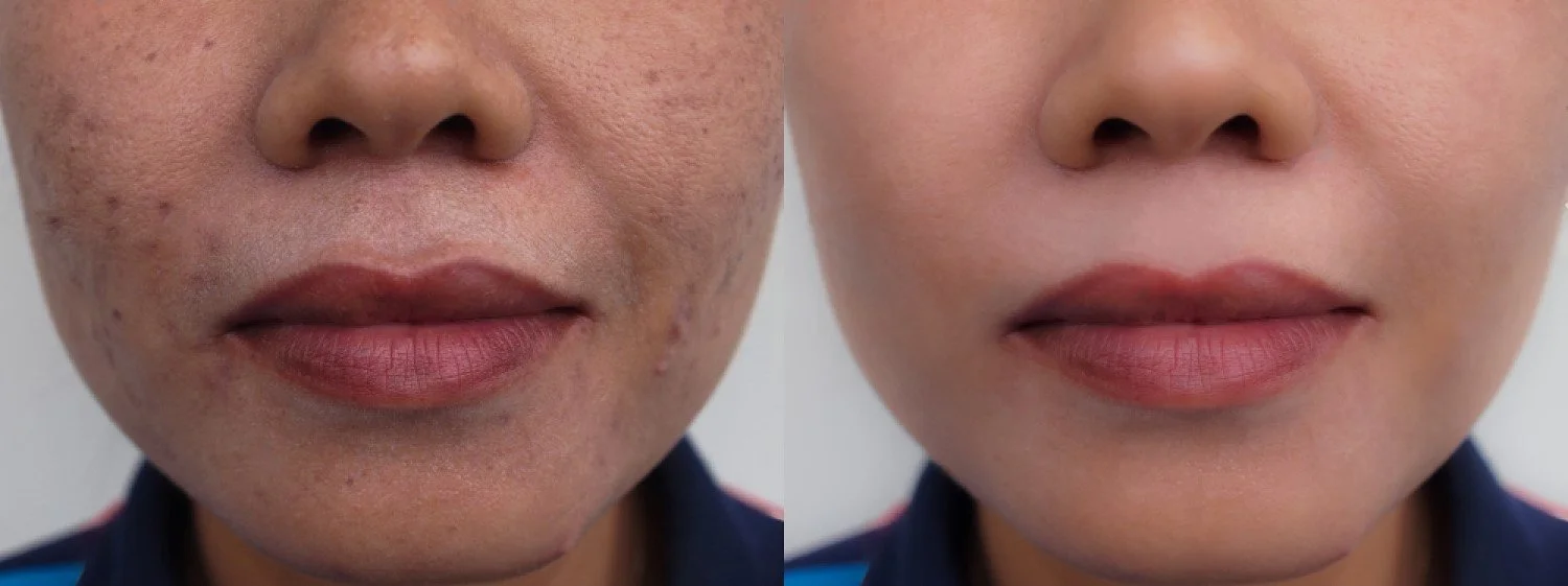 Treatments For Dark And Pigmented Lips