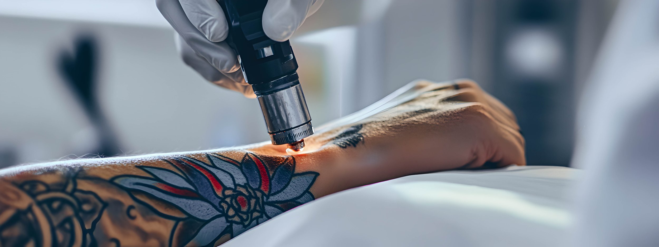 💫✨ Laser Tattoo Removal: Clear Your Skin at Belleza 360° Aesthetics 💫