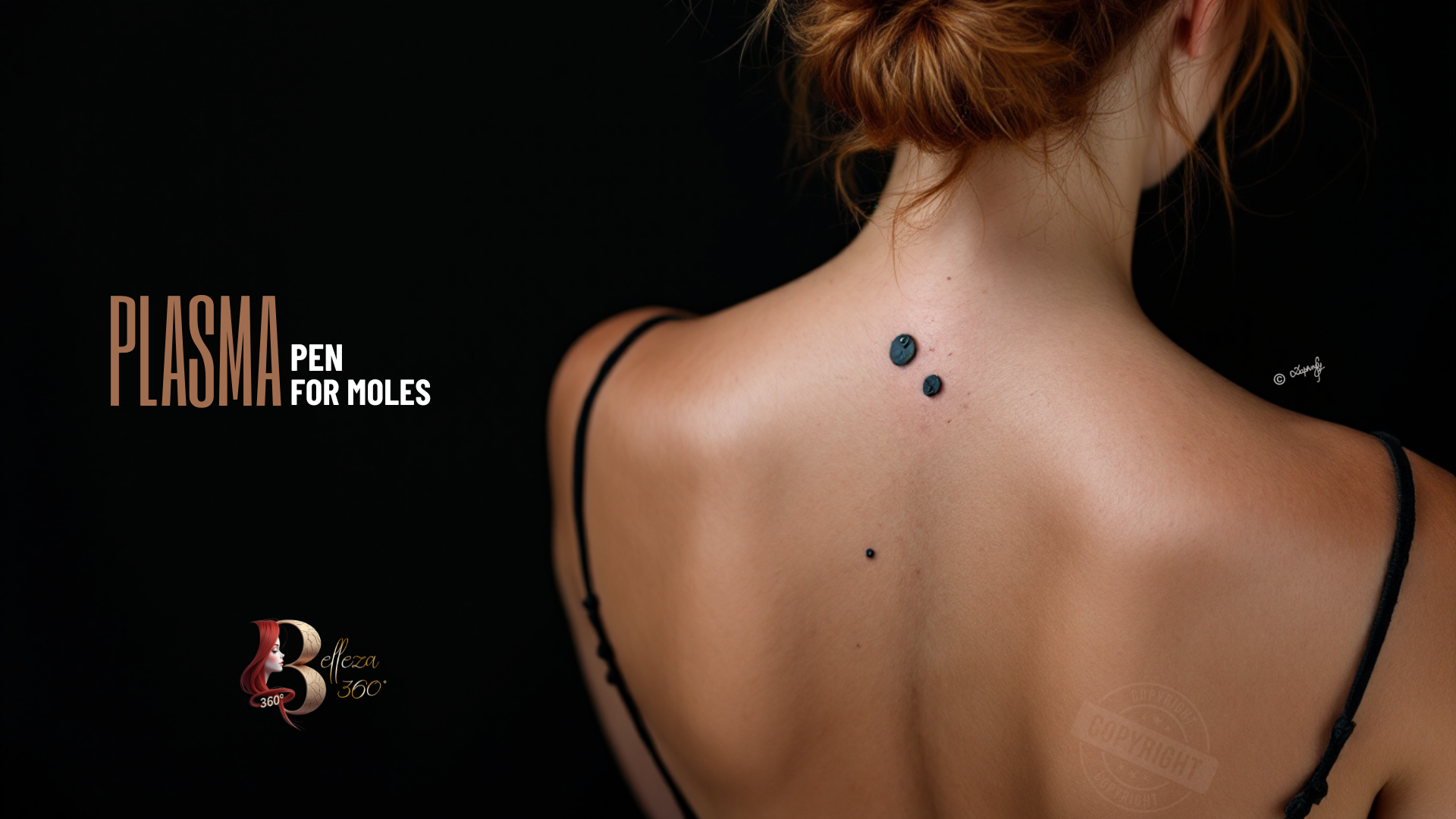 ✨PLASMA PEN FOR MOLES At Belleza 360° Aesthetics🌟
