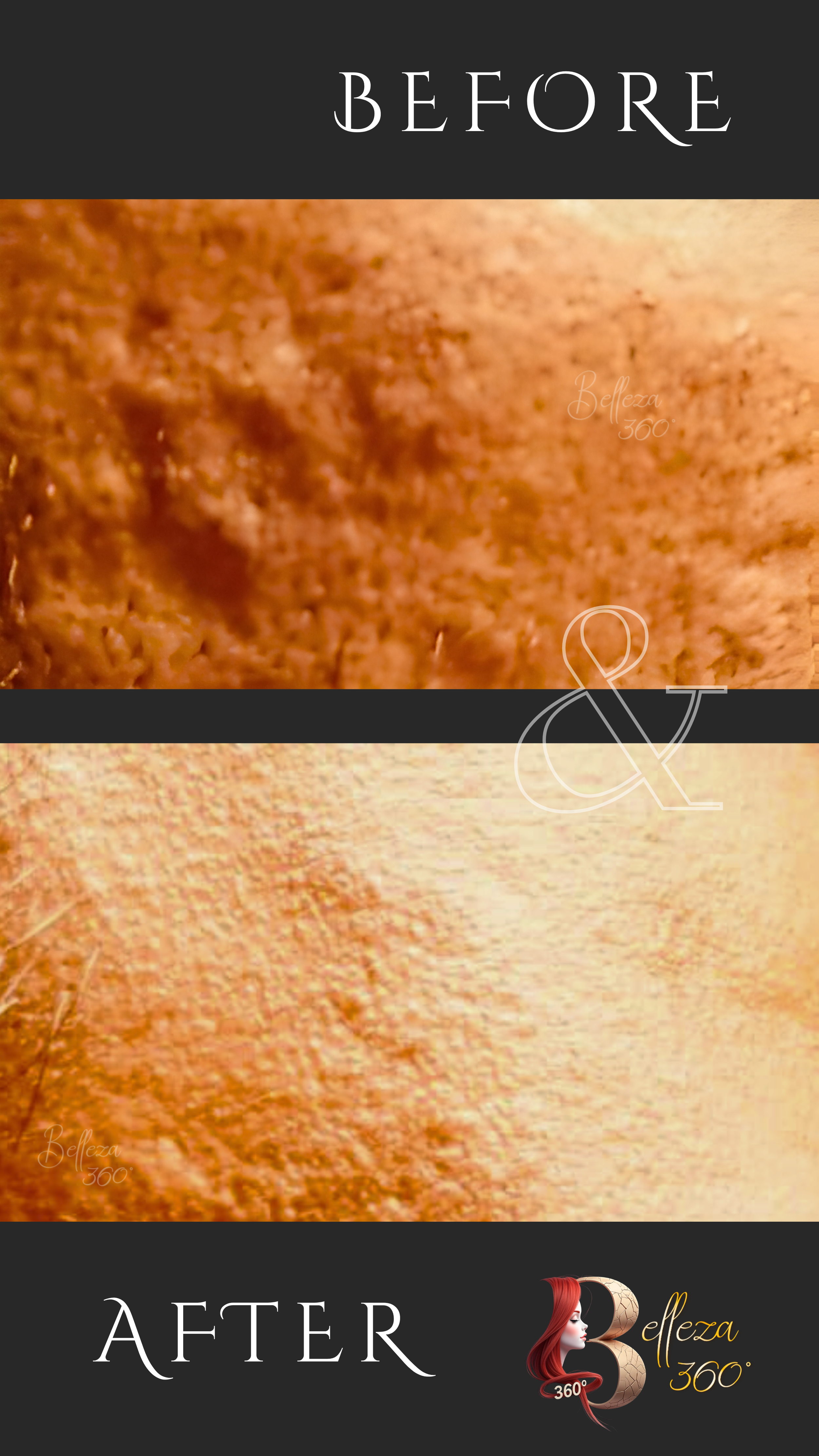 acne scar removal treatment, best acne scar clinic, acne scar laser treatment, dermatologist for acne scars, acne scar removal near me, effective acne scar therapy