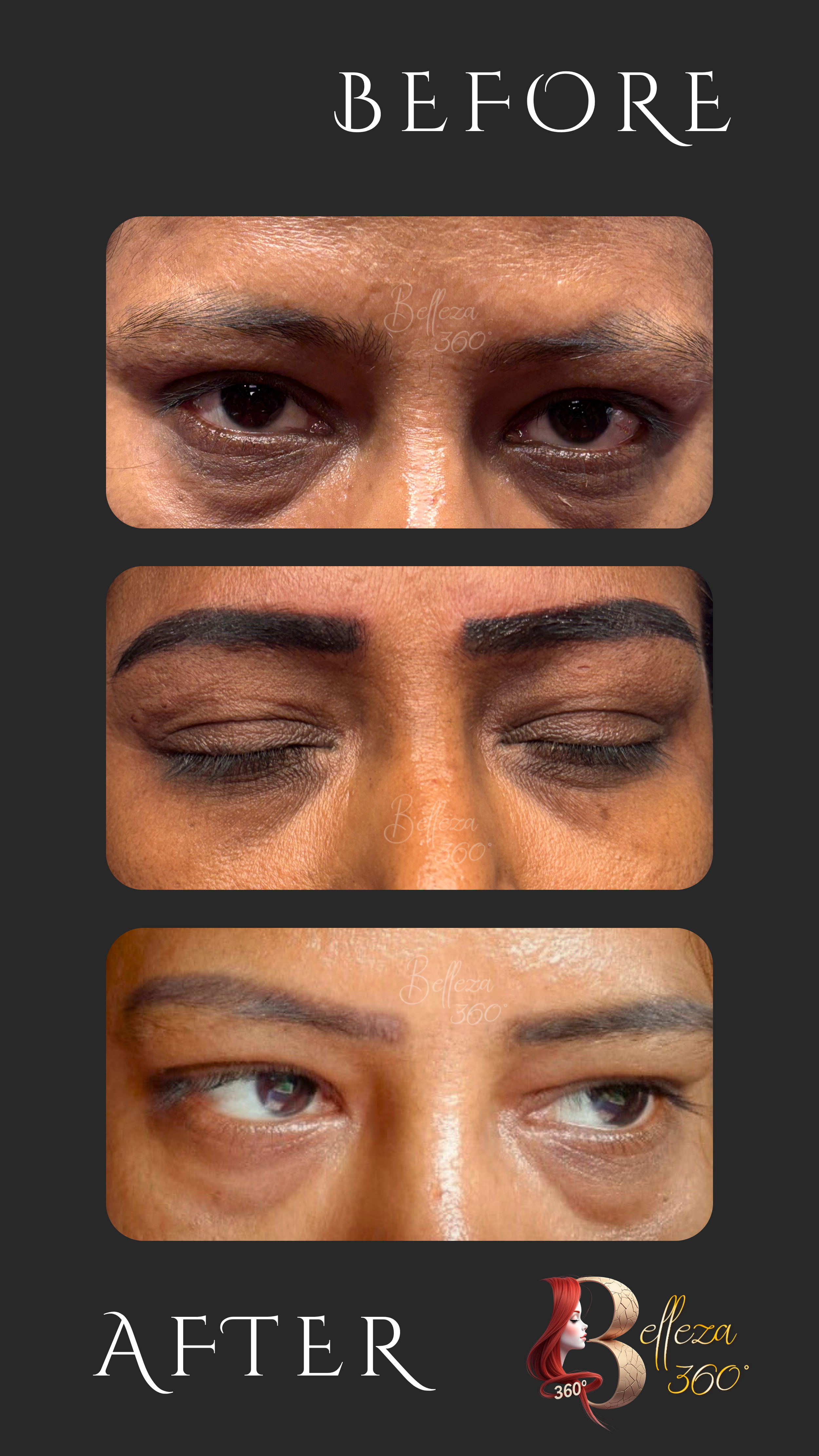 undereye peel treatment, dark circle peel Chennai, under eye pigmentation treatment, powder brow Chennai, powder brows treatment, semi permanent eyebrow treatment
