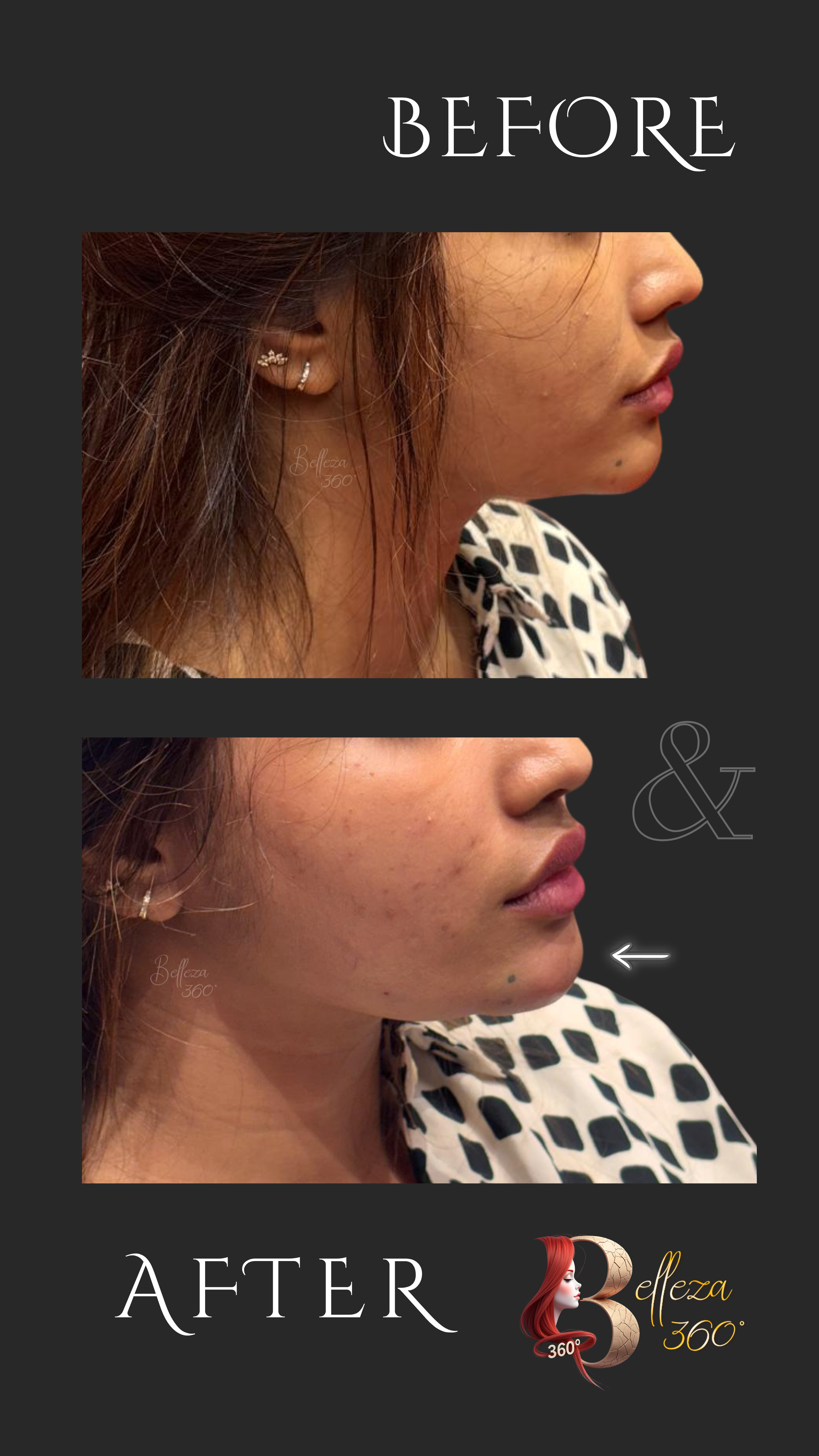 Chin and pre-jowl sulcus filler in Chennai, Jawline filler treatment Chennai, Non-surgical chin enhancement Chennai, Pre-jowl sulcus correction Chennai, Chin and jawline contouring filler Chennai, Dermal fillers for chin and jawline Chennai