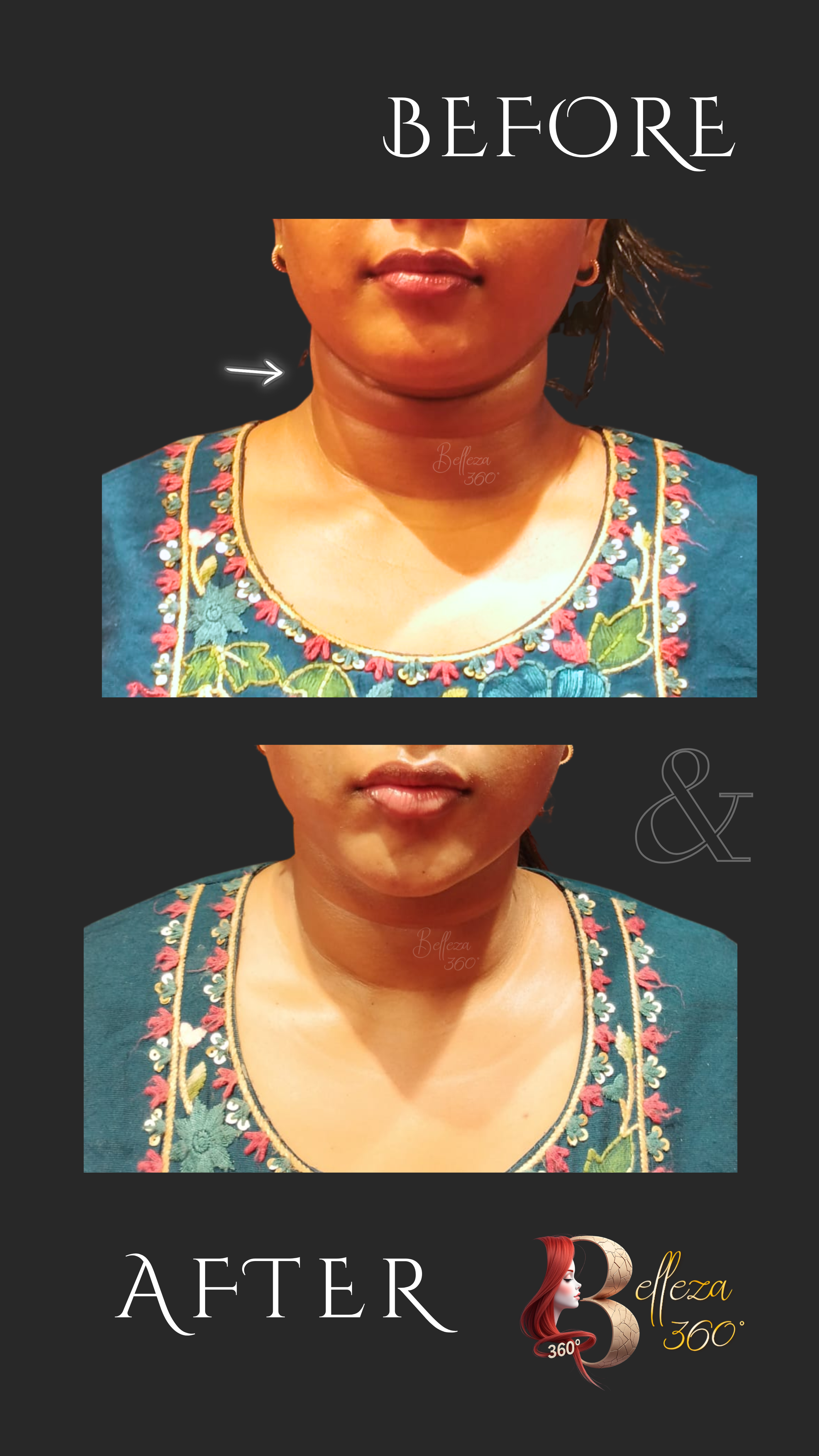 Exilis neck tightening Chennai, Best Exilis treatment in Chennai, Neck lift clinic Chennai, Non-surgical neck tightening Chennai, Exilis skin tightening Chennai, Best skin clinic in Chennai