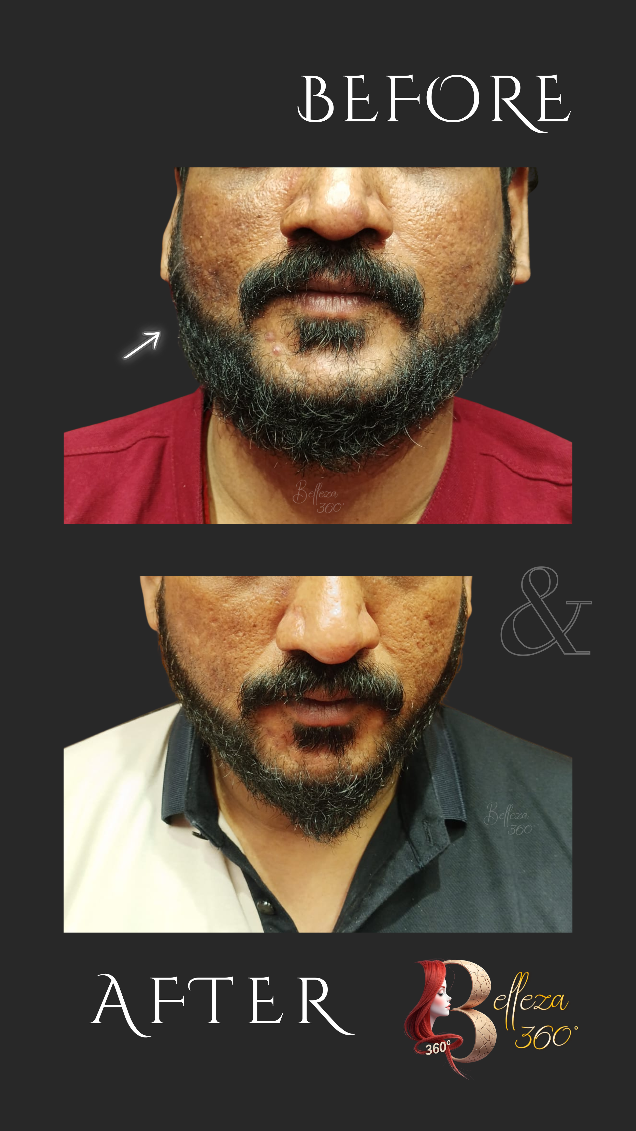 Laser Pigmentation removal Chennai, Pigmentation treatment laser, Skin pigmentation correction, Best laser clinic Chennai, Dark spot removal laser, Uneven skin tone treatment Chennai
