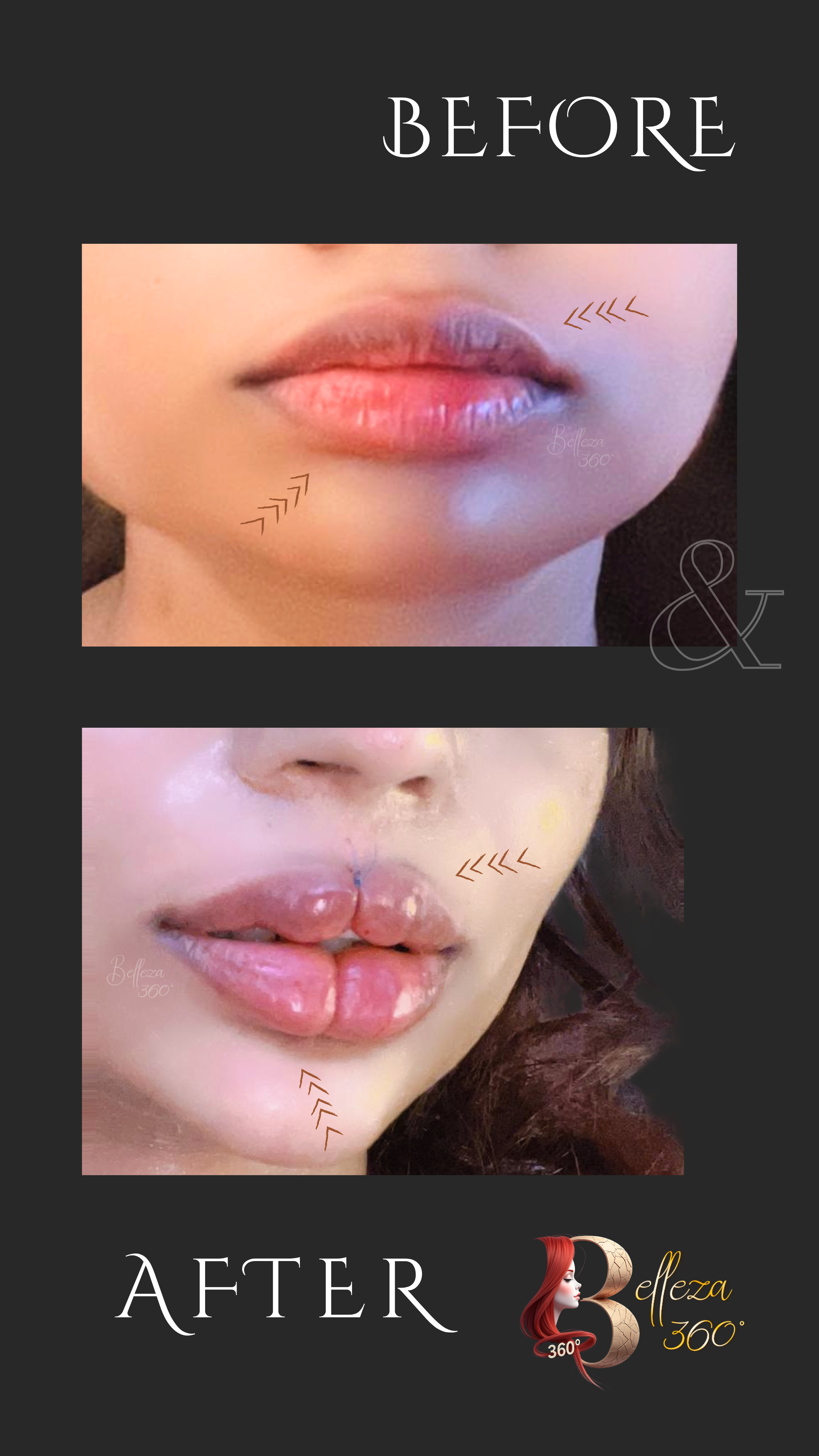 Keyhole lip filler in Chennai, Keyhole lip augmentation Chennai, Non-surgical keyhole lip filler Chennai, Best keyhole lip filler clinic Chennai, Keyhole lip filler cost in Chennai, Dermal fillers for keyhole lips Chennai